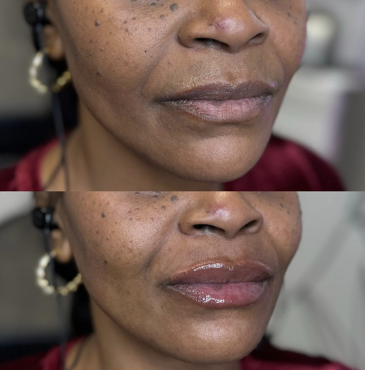 Before and after of a mature lip filler client with darker skin, showing improved lip fullness and smoothness after treatment.