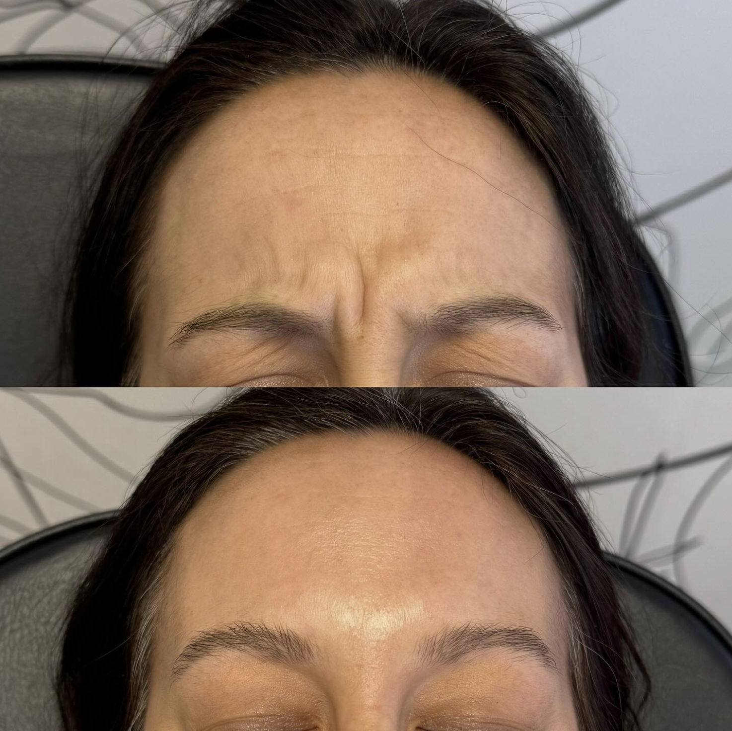 Before and after images of a woman showing forehead wrinkles reduction, top image with wrinkles and bottom image smooth forehead after treatment.