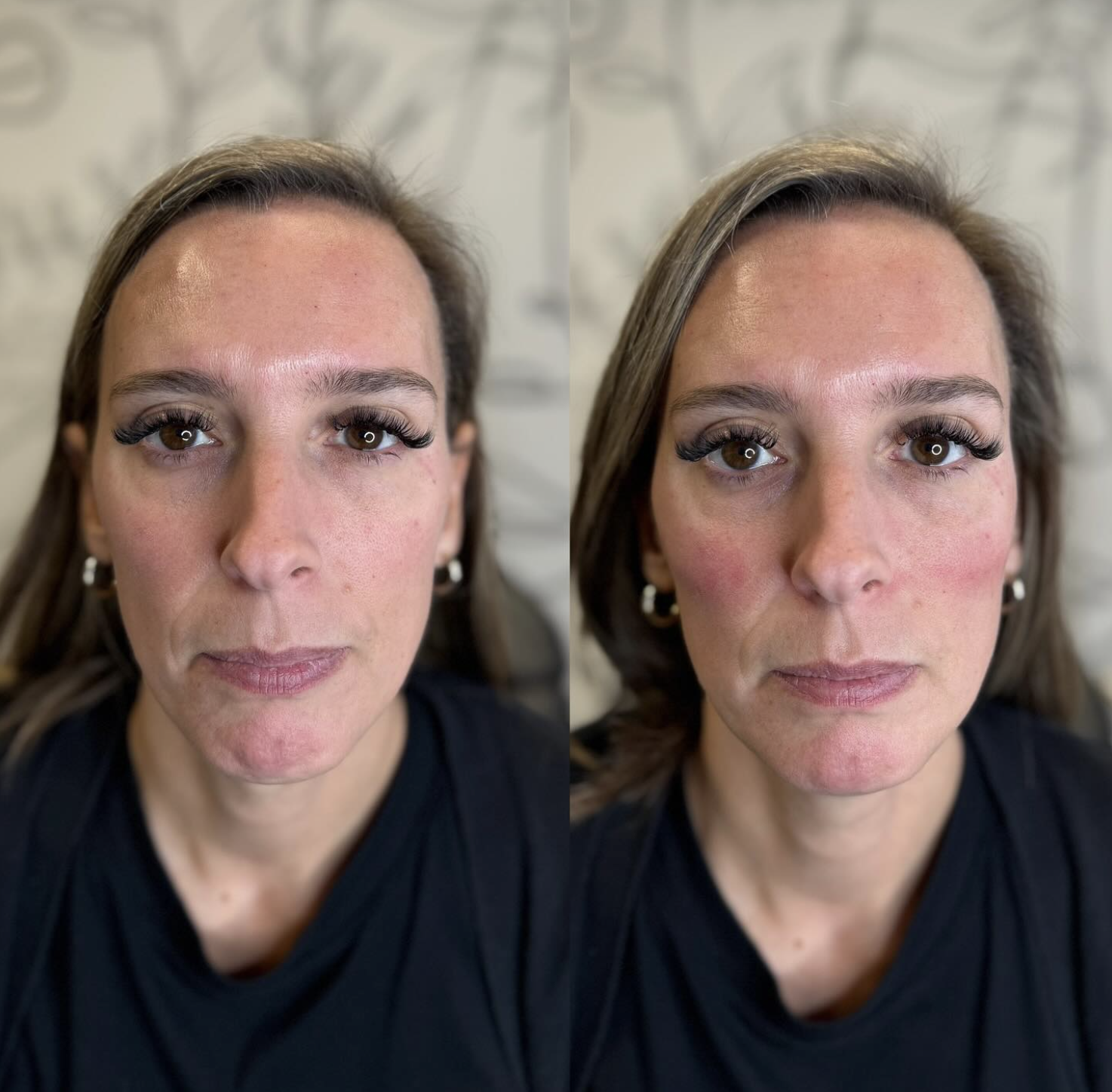 Side-by-side comparison of a woman before and after cheek filler.