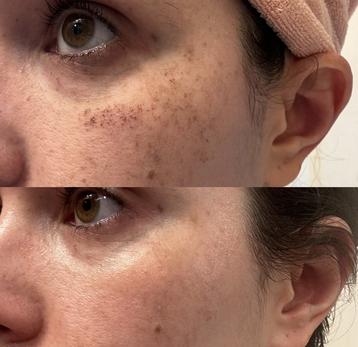 Close-up of a person's face before and after an IPL laser treatment, showing reduced freckles, dark spots, and improved skin texture.