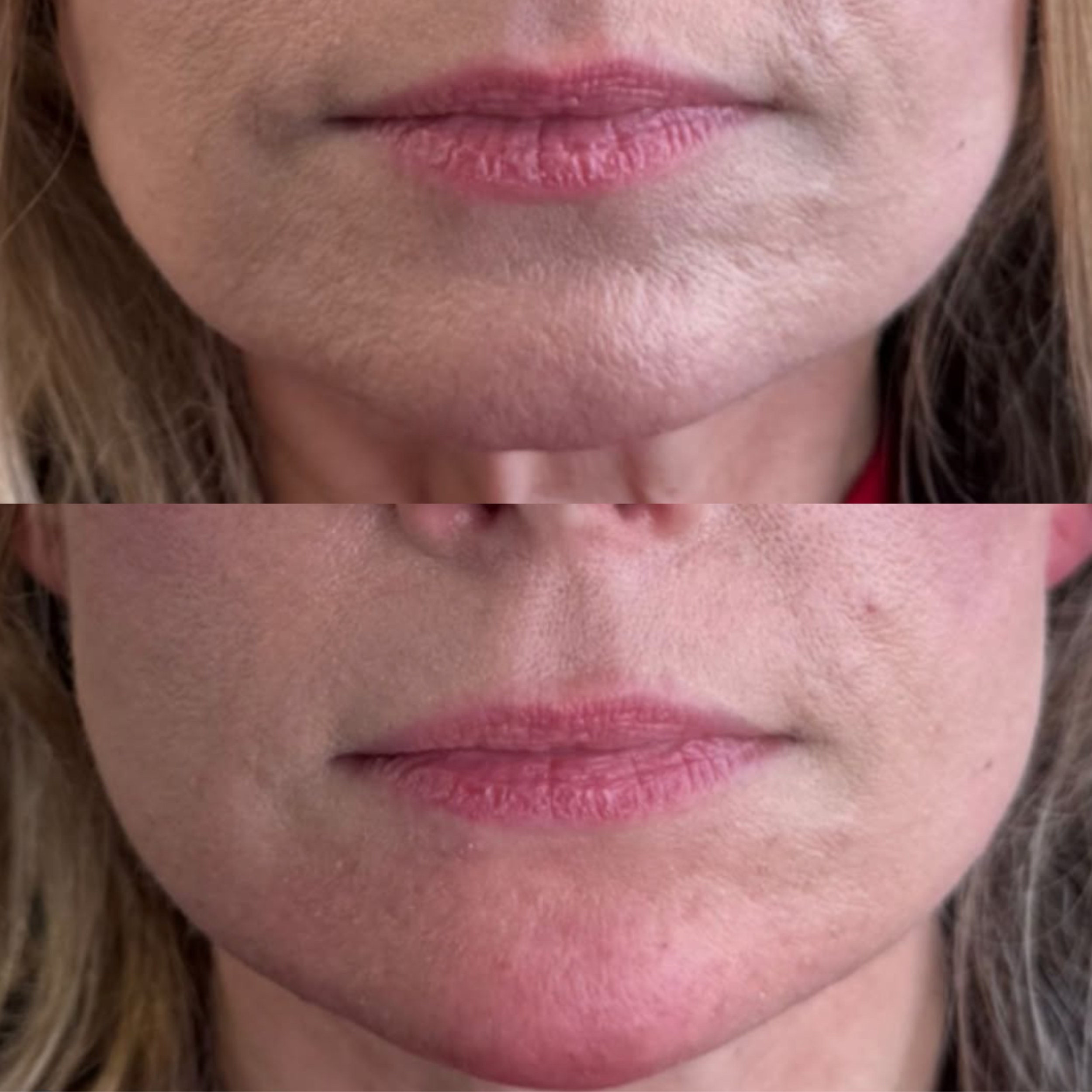 Close up shot of before & after, showing a who received chin filler for a more elongated, balanced appearance. 