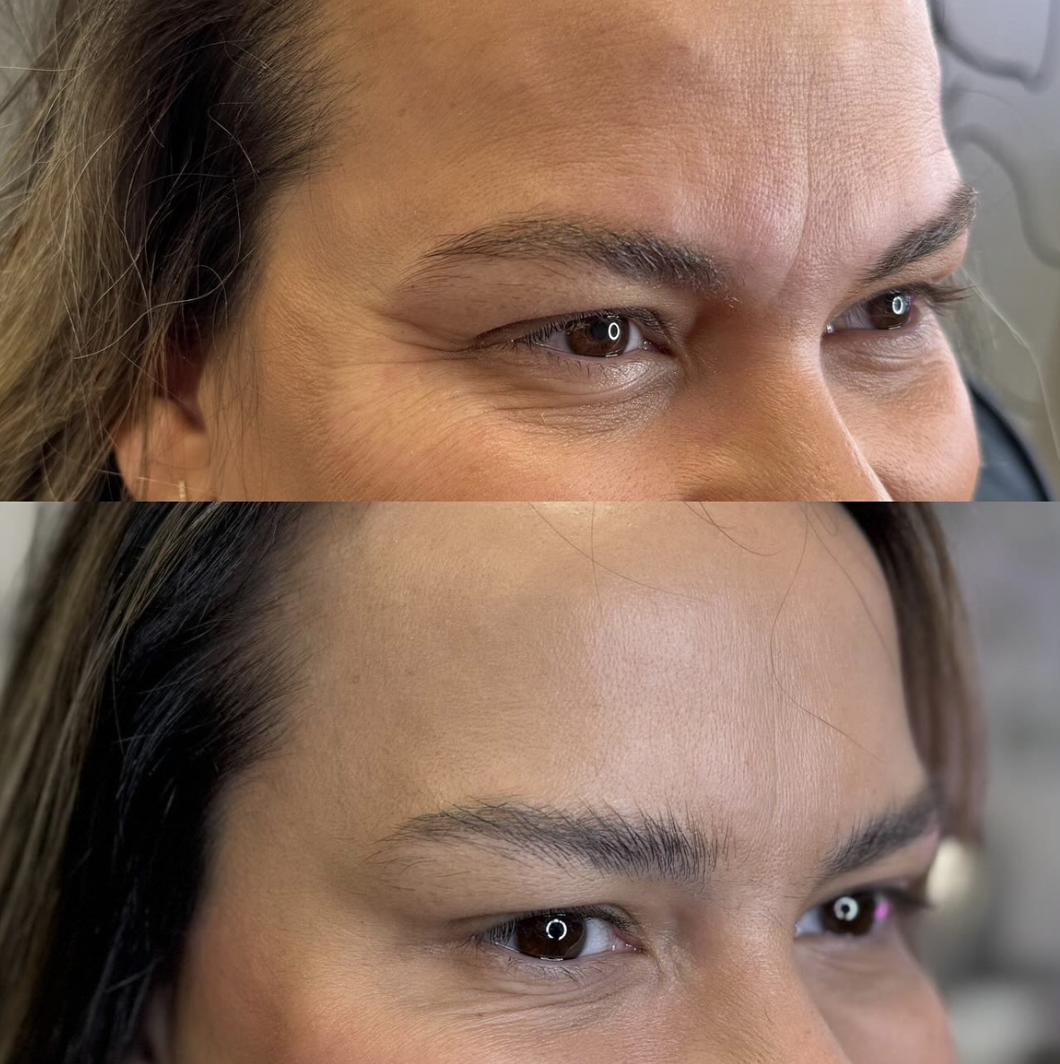 Close-up of a person's crows feet before and after receiving Botox, with smoother texture in the after image.