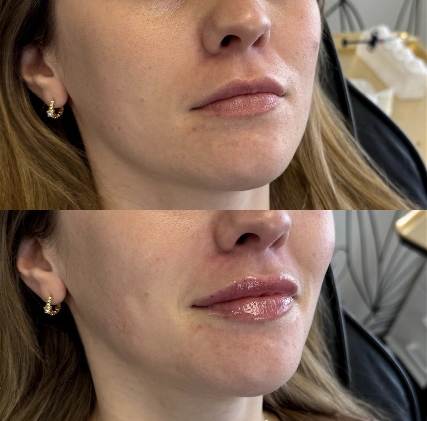 Close-up of a woman's face before and after lip filler appointment.