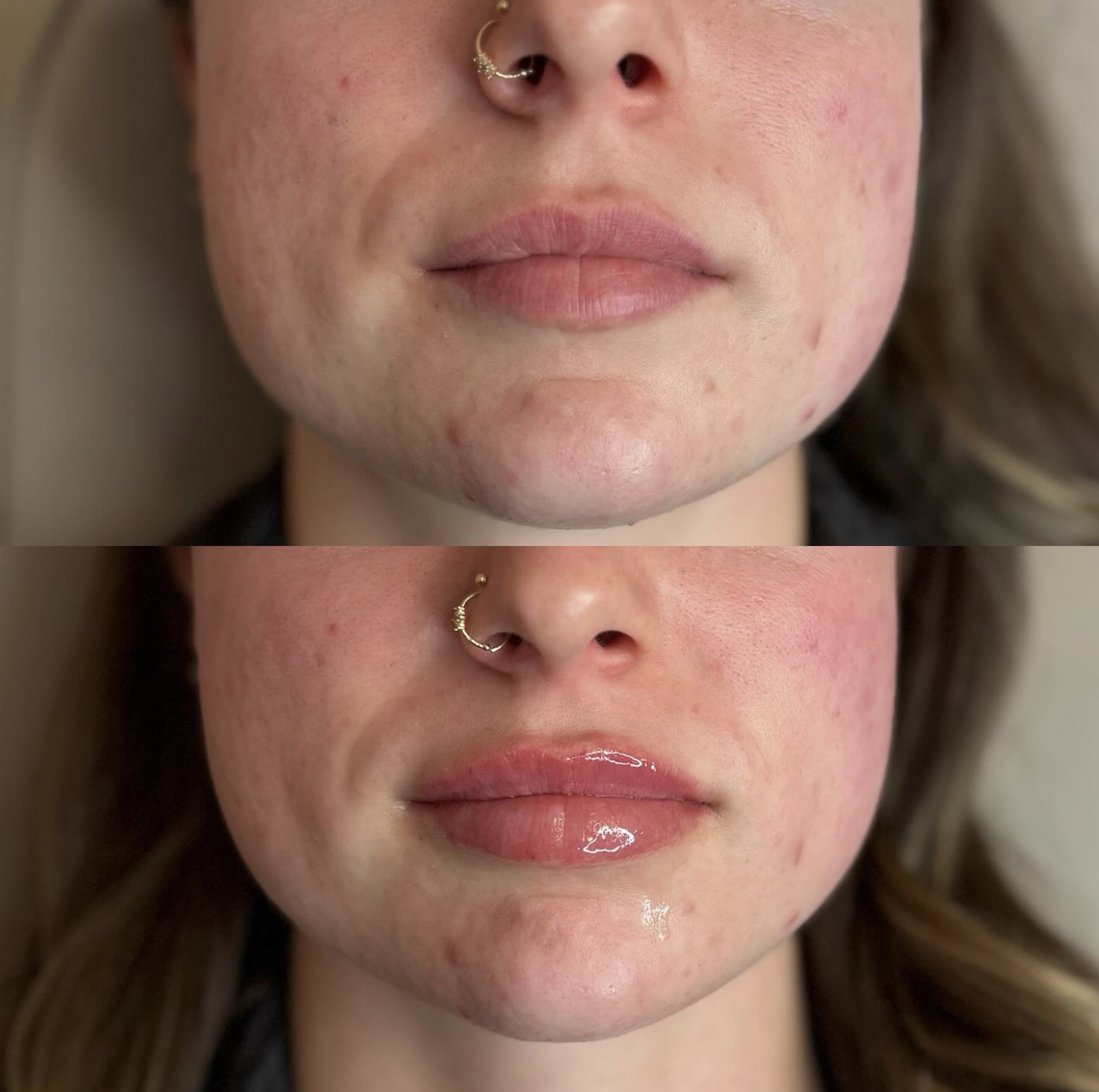 Before and after of a lip filler client, showing improved lip fullness and smoothness after treatment.