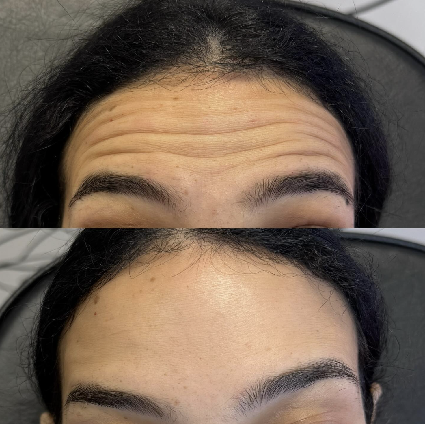 Comparison of forehead with multiple horizontal wrinkles before and smoothed skin after treatment.