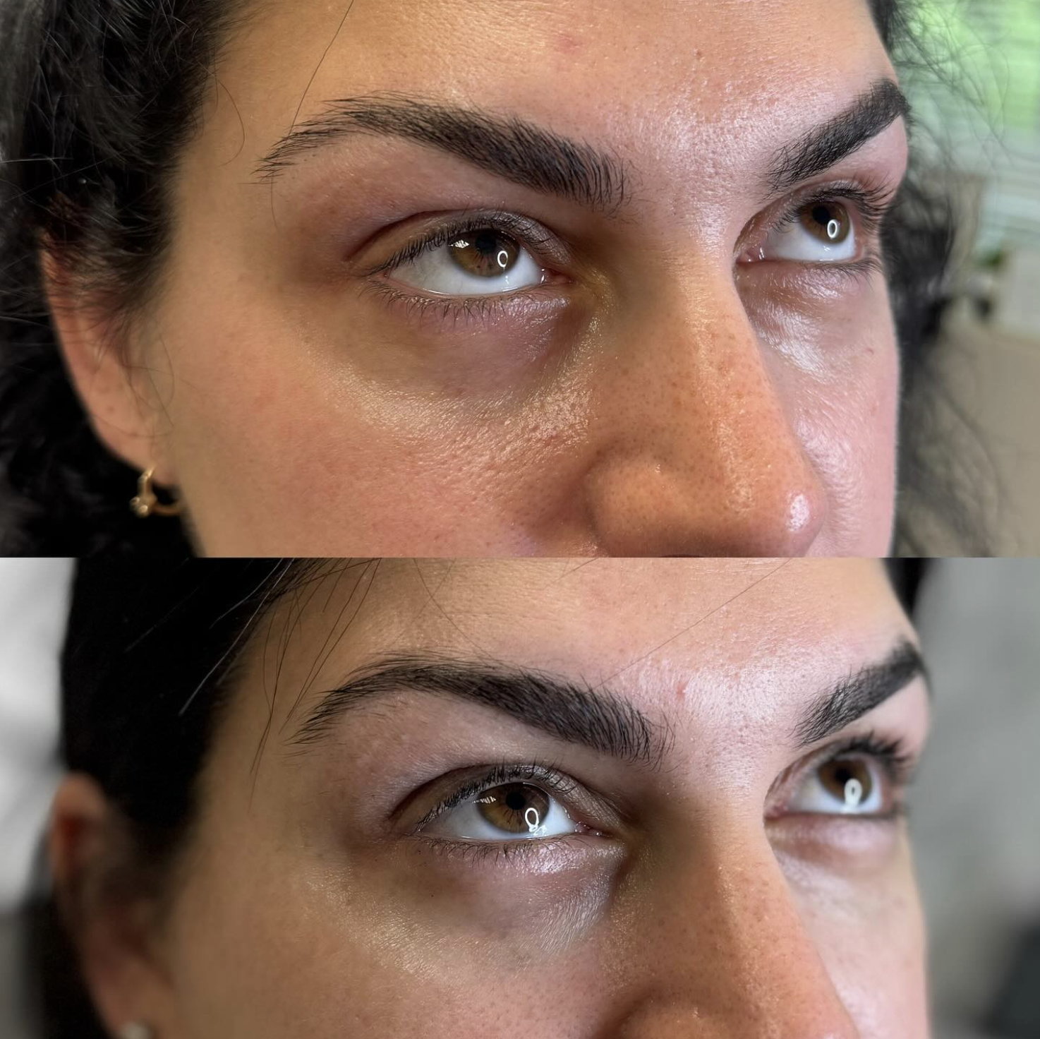 Close-up of a woman's face before and after under eye filler.