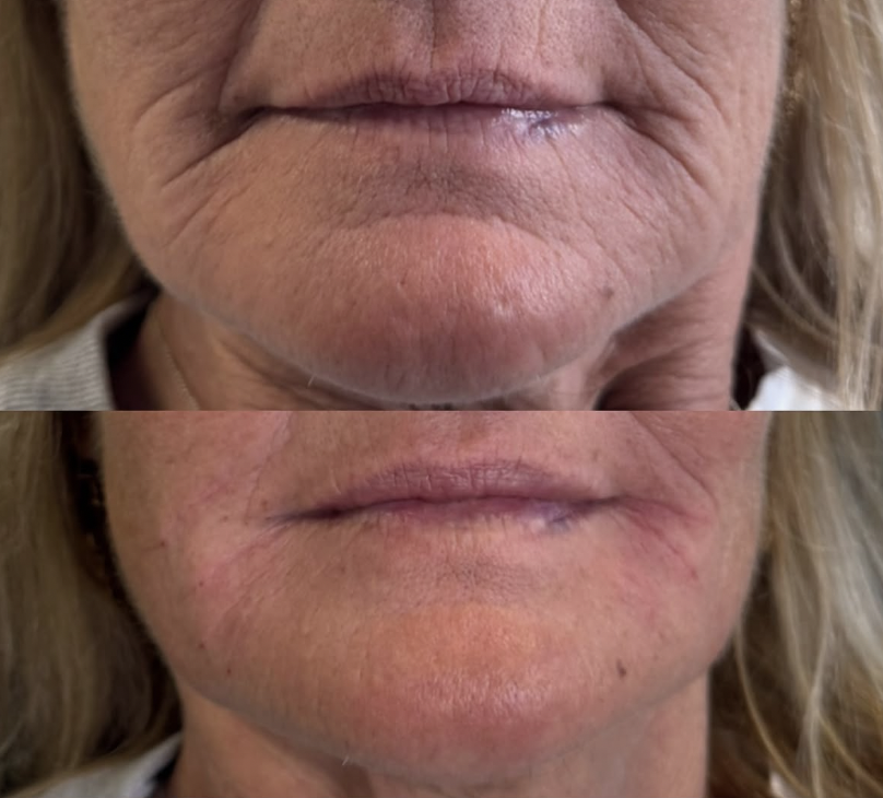 Close-up images of a person's mouth showing wrinkles and skin texture, likely displaying before and after results of a skincare or cosmetic procedure.