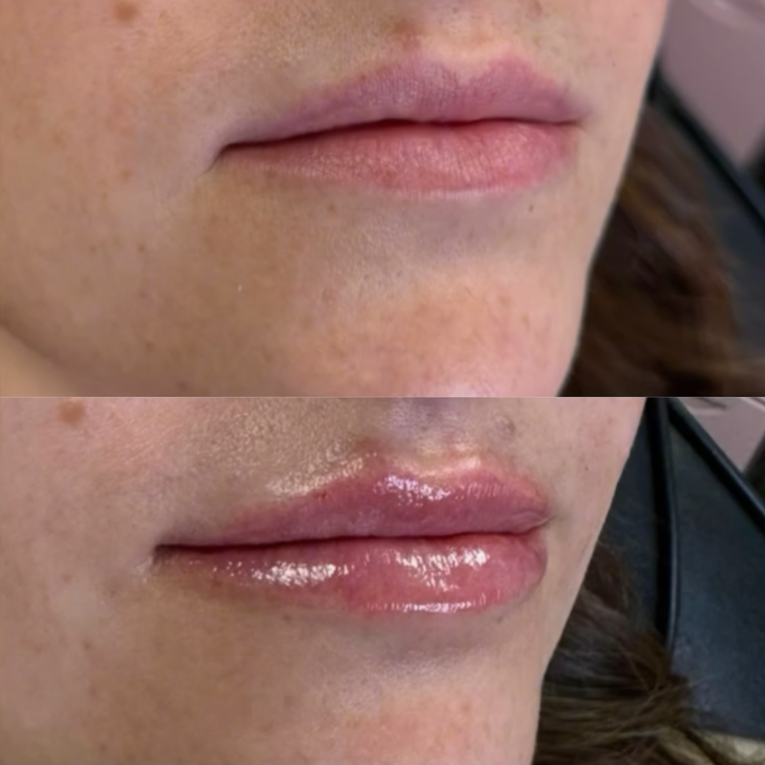 Before and after of a lip filler client, showing improved lip fullness and smoothness after treatment.