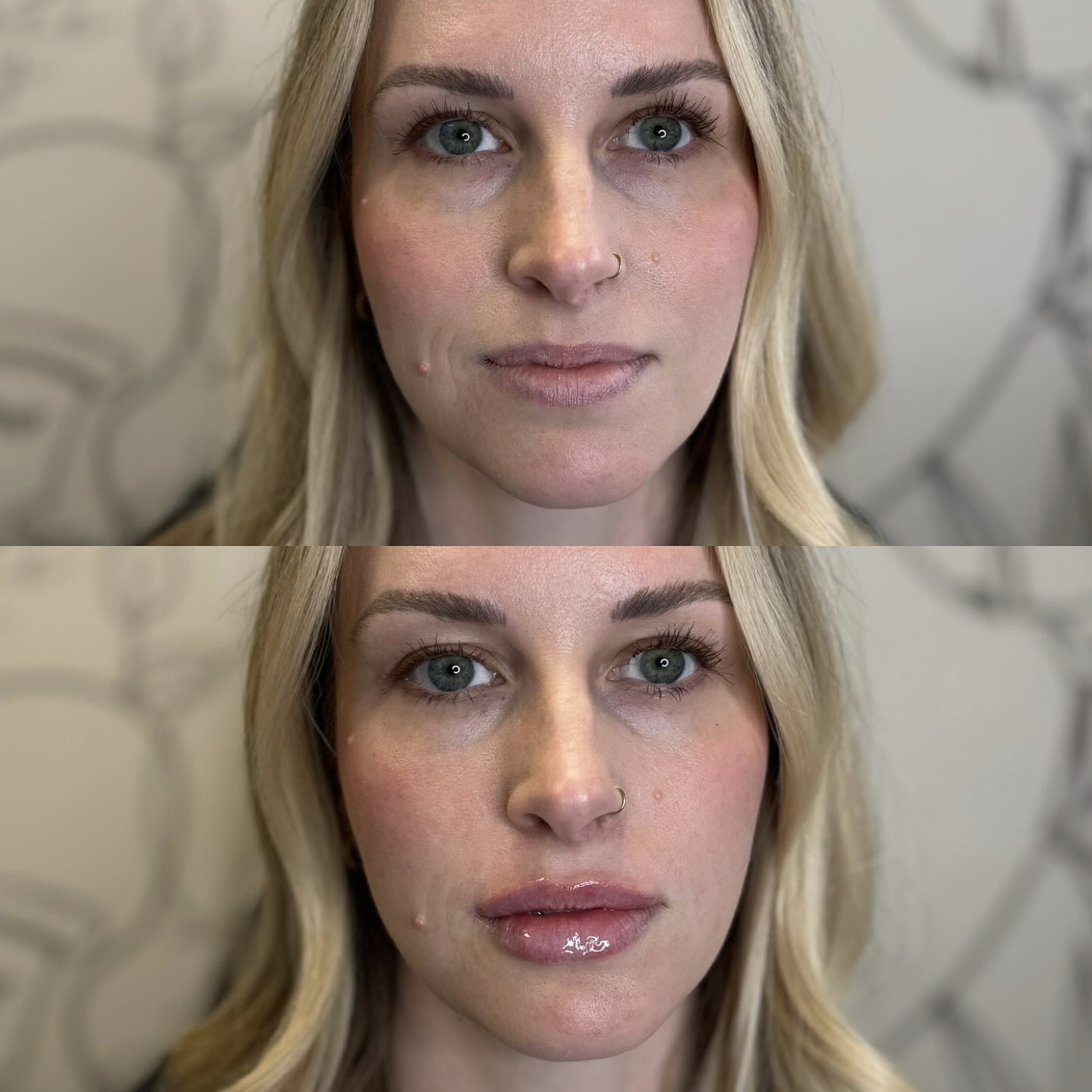 Close-up of a woman with blonde hair and blue eyes, showing before and after lip filler treatment, with glossy lips in the after image.