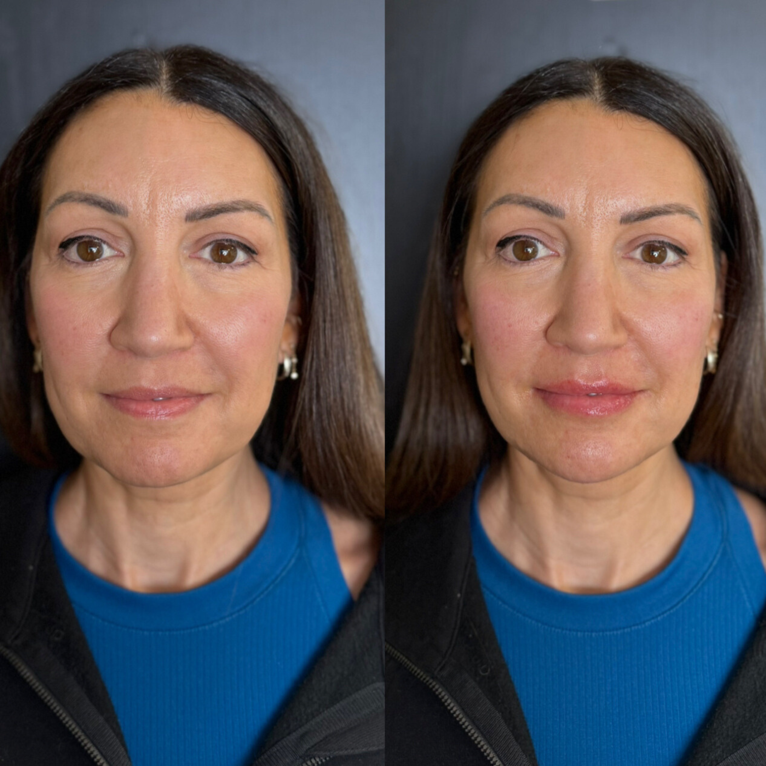 Side-by-side comparison of a woman before and after natural filler in her cheeks and lips.