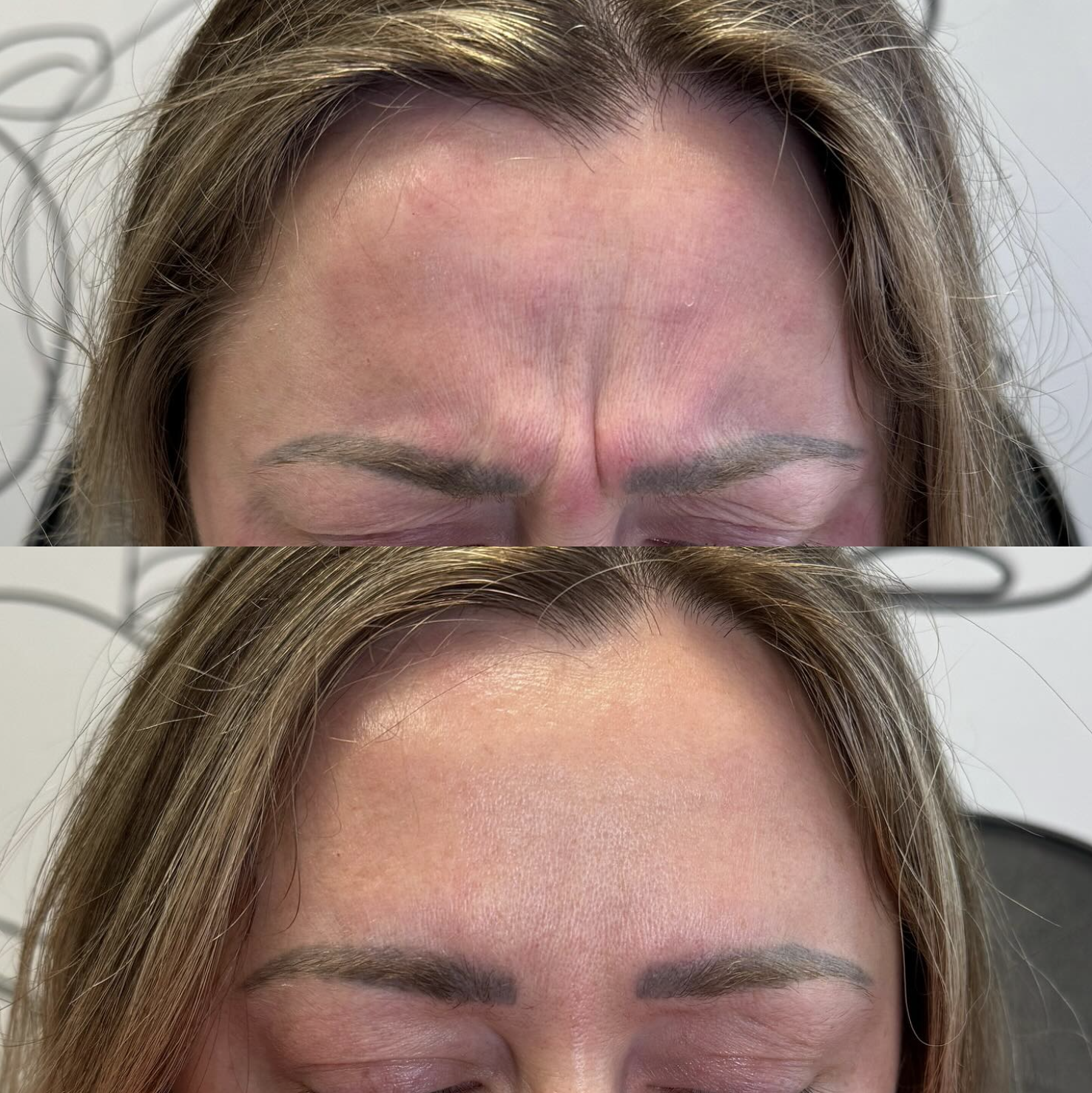 Close-up of a woman's forehead showing before and after botox treatment; the before image shows frown lines, and the after image shows smooth skin.