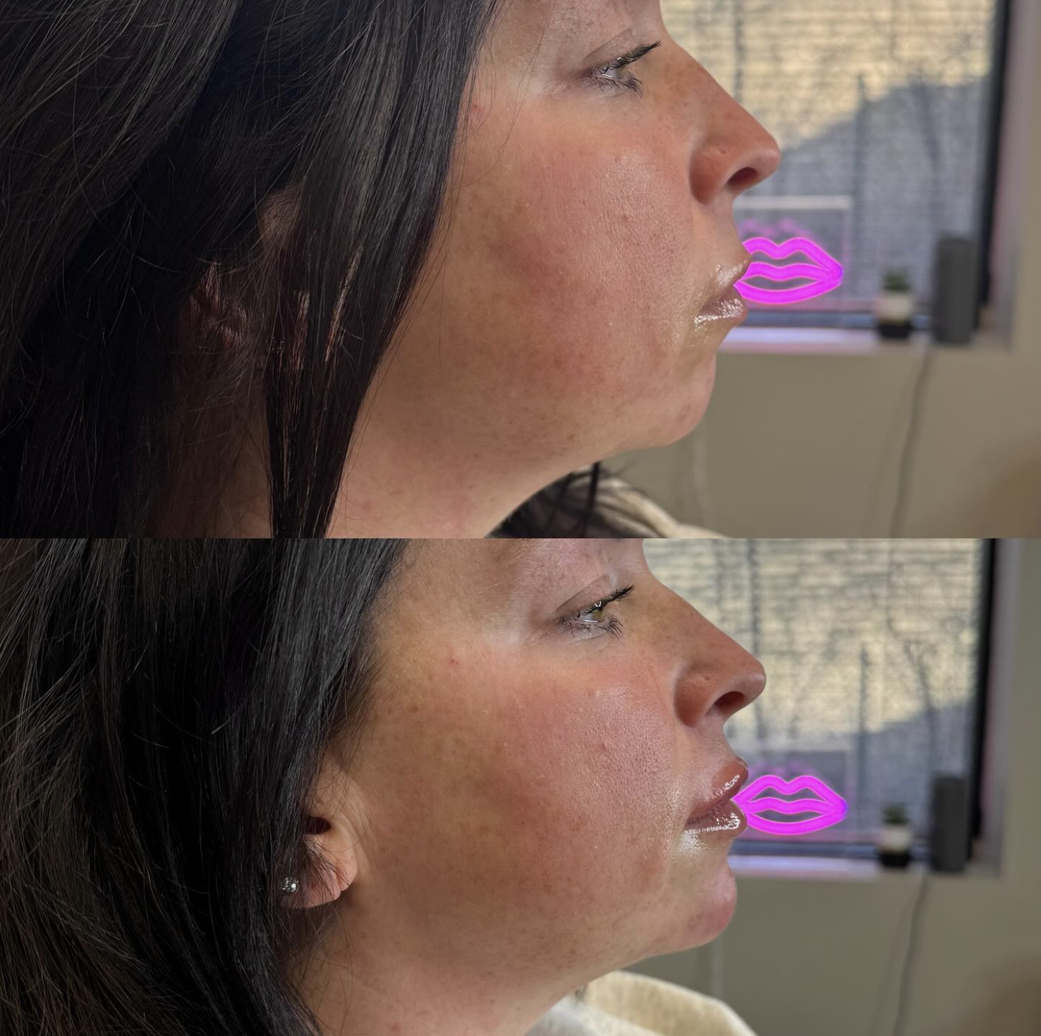 Side-by-side comparison of a woman's profile before and after getting filler in the chin. 