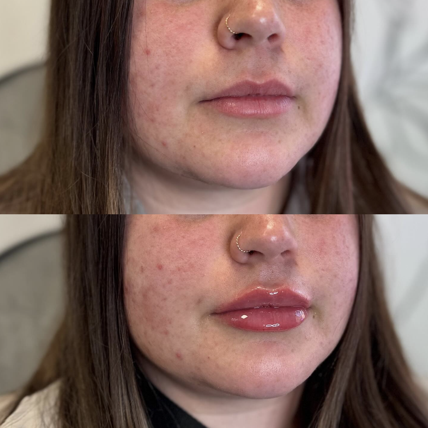 Close-up of a woman's face showing before and after lip filler appointment, with natural skin and a nose piercing.
