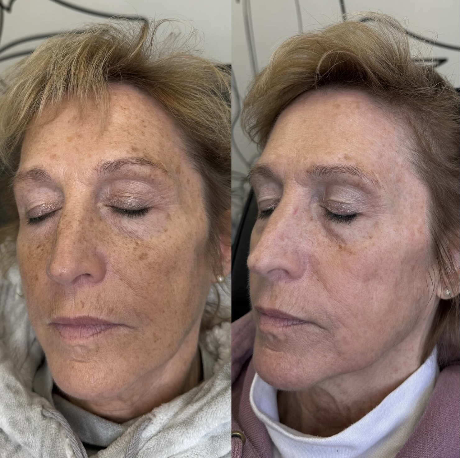 Before and after photos of a woman with freckles and skin discoloration, showing recent skin improvement after IPL laser facial.