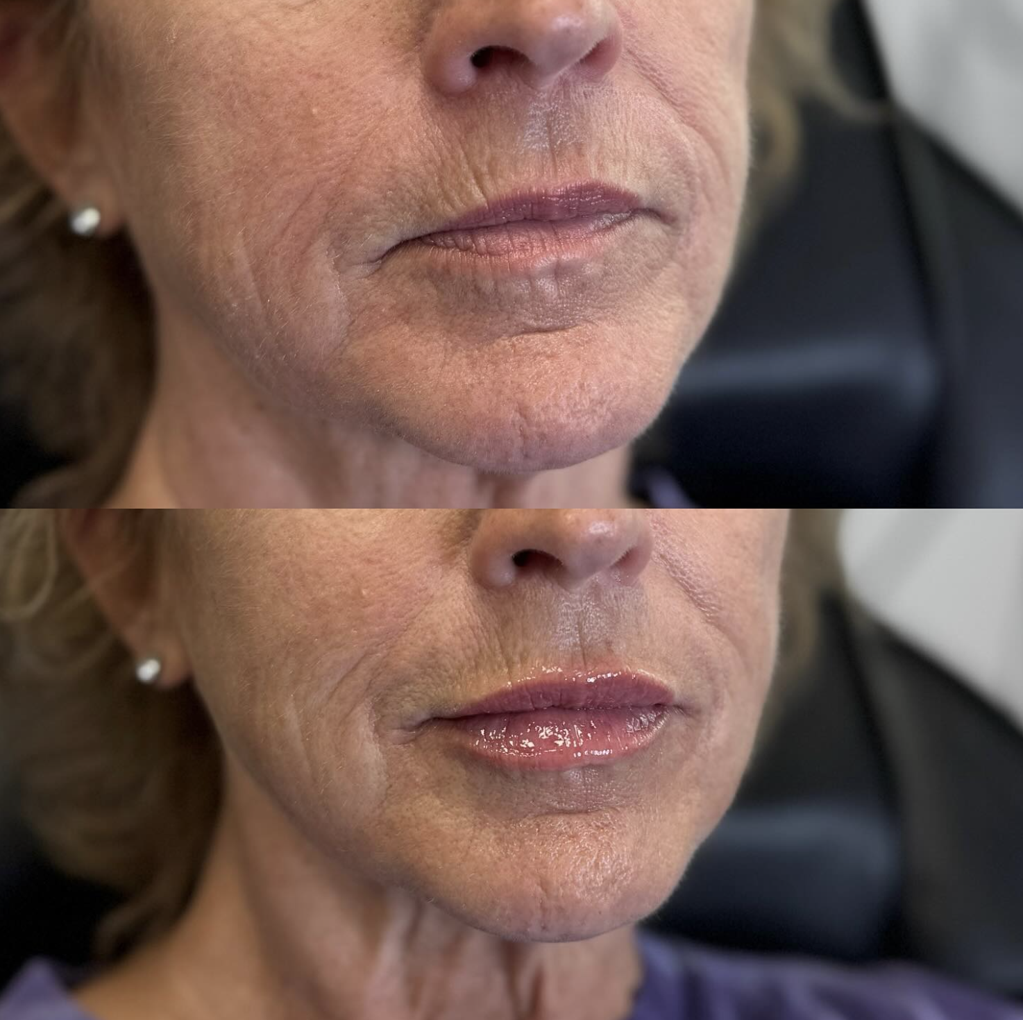 Close-up of a mature woman’s face, showing before and after images of cosmetic lip enhancement, with the lower image depicting lips with a glossy finish.