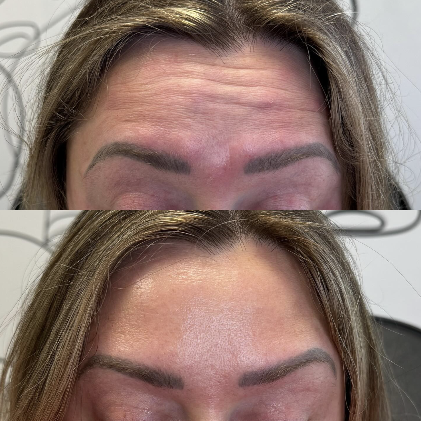 Close-up of a woman's forehead before and after Dysport, showing reduced wrinkles and improved skin texture.