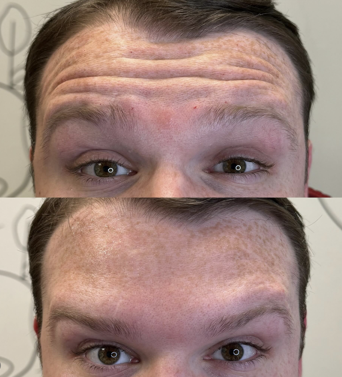 Close-up of a person's forehead showing before and after receiving Botox, with smoother texture in the after image.