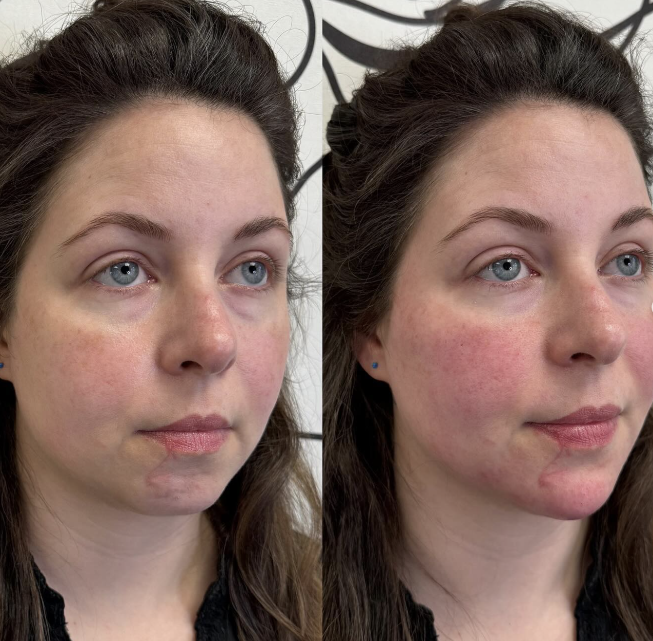 Side-by-side before and after photos of a woman showing improvements in chin and cheeks after using filler.