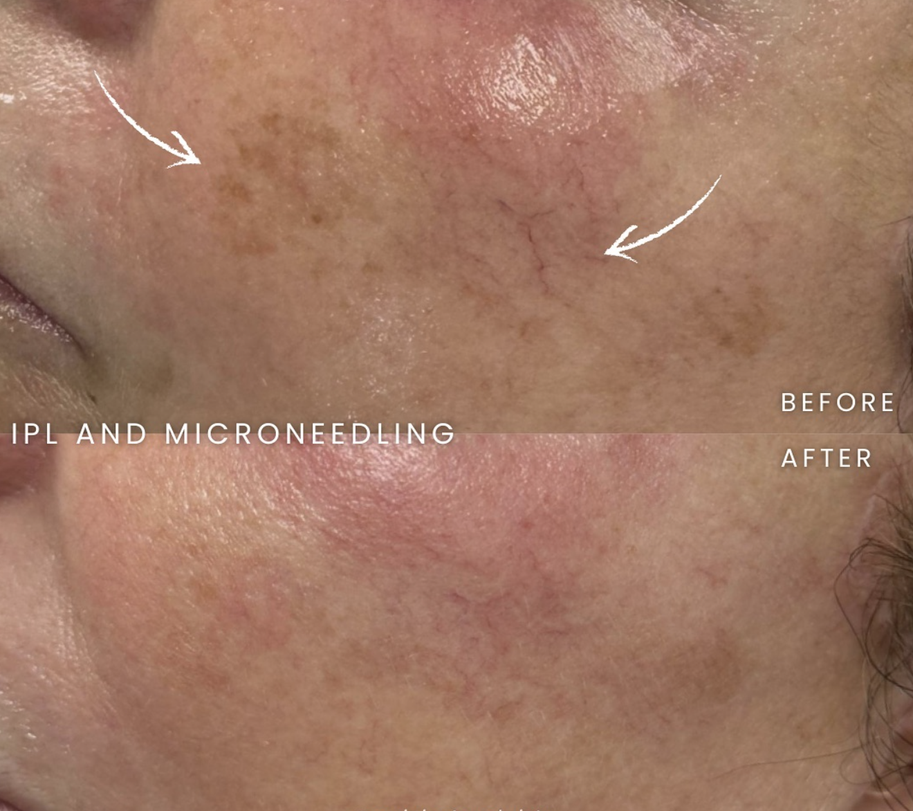 A close-up comparison of skin showing before and after results of IPL and microneedling treatments. The 'before' image displays sun damage, hyperpigmentation, and redness, while the 'after' image shows clearer, more even-toned skin.