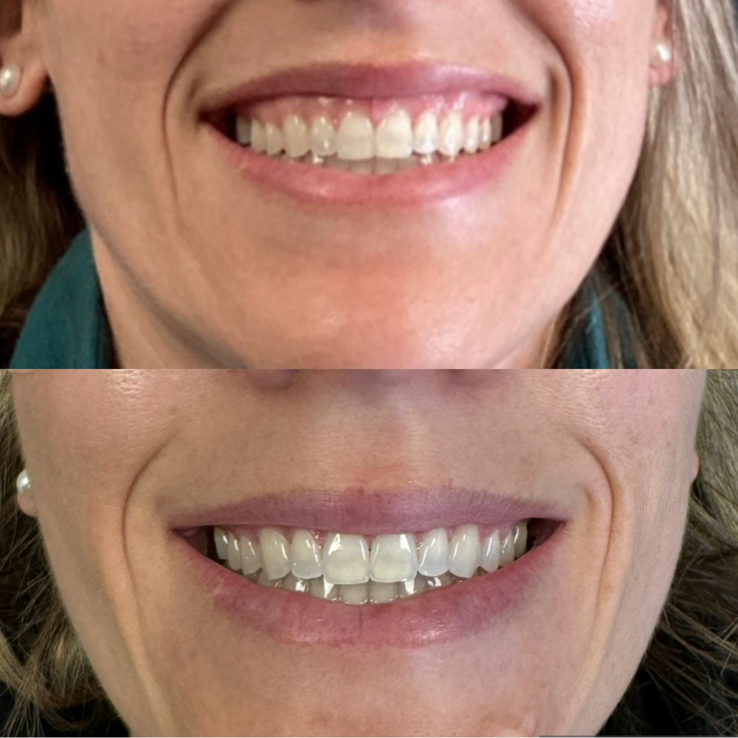 Comparison of a person's teeth before and after receiving Botox and a Lip Flip, showing improvement in lip fullness when smiling.