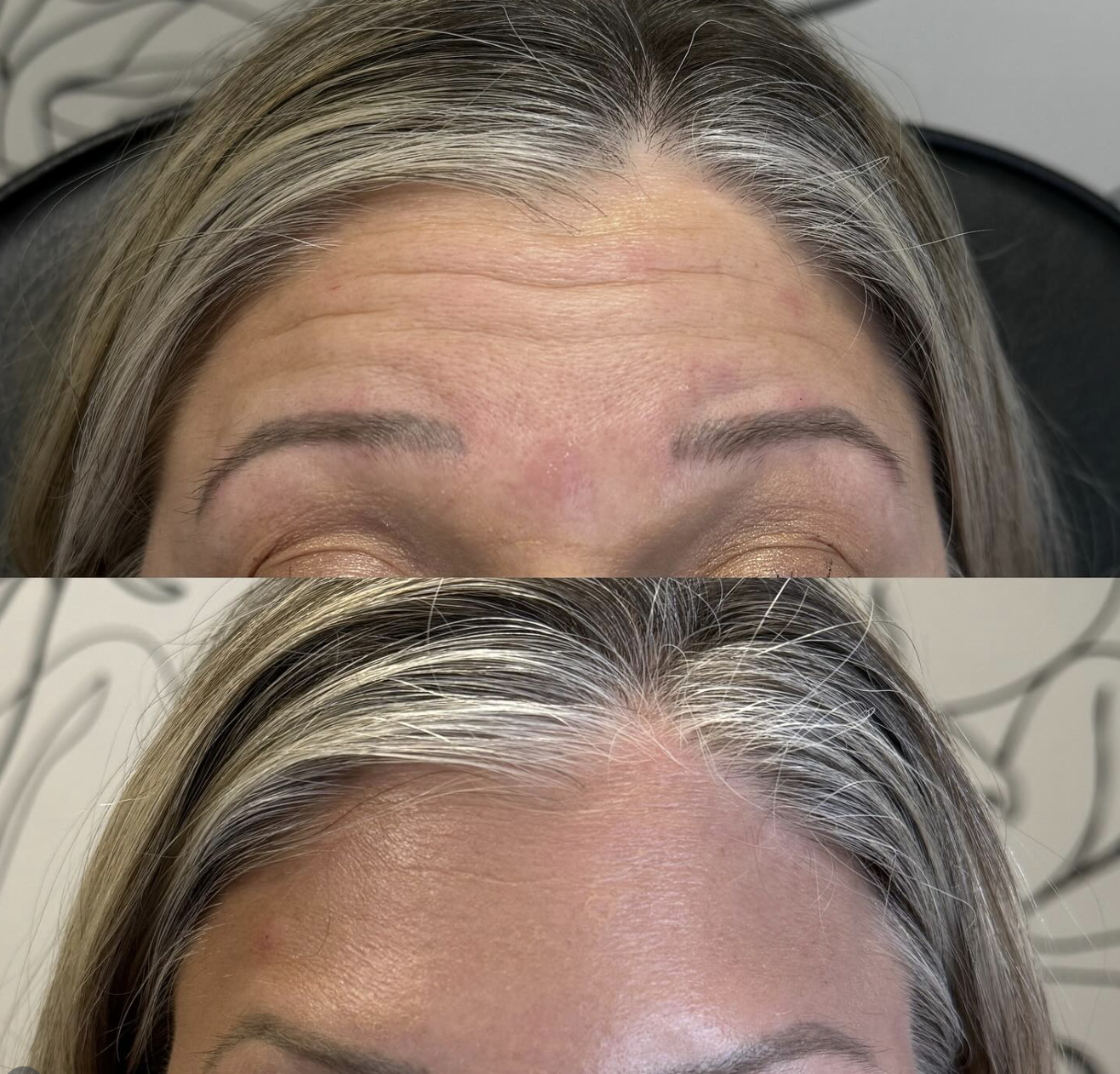 Close-up of a woman's forehead before and after Botox, showing reduced wrinkles and smoother skin in the after image.