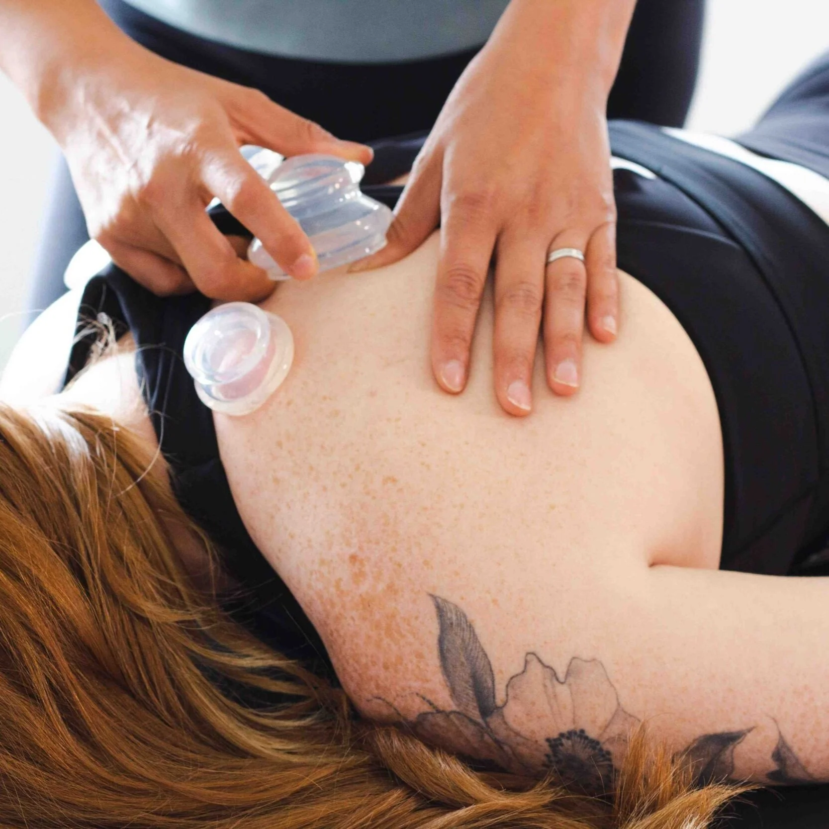 Physiotherapist using cupping therapy on patients back