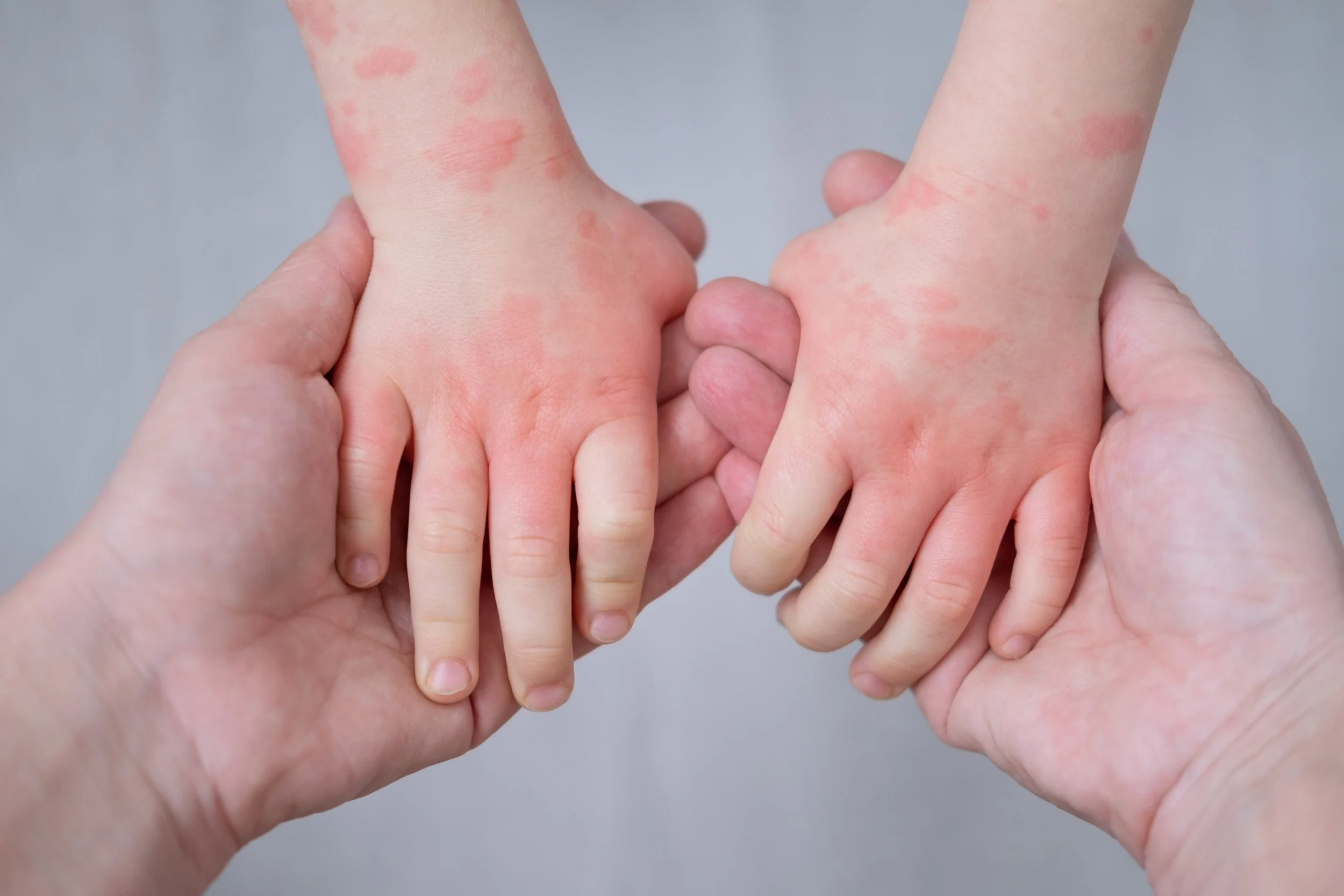 Two pairs of hands holding smaller hands, with redness and rash on the smaller hands' skin.