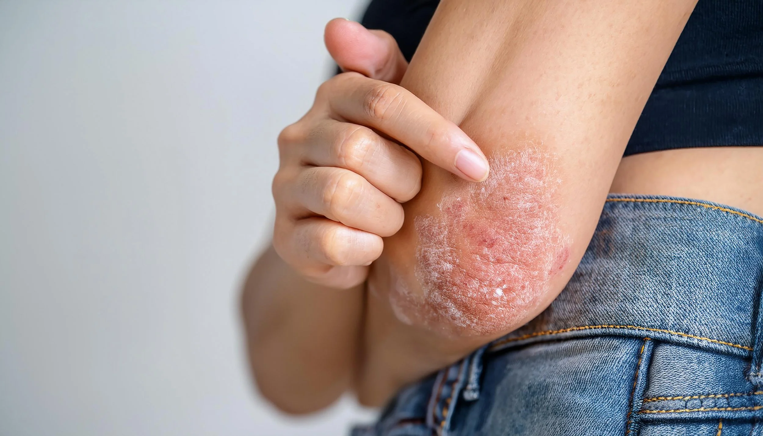 Person scratching their arm with skin irritation and redness.
