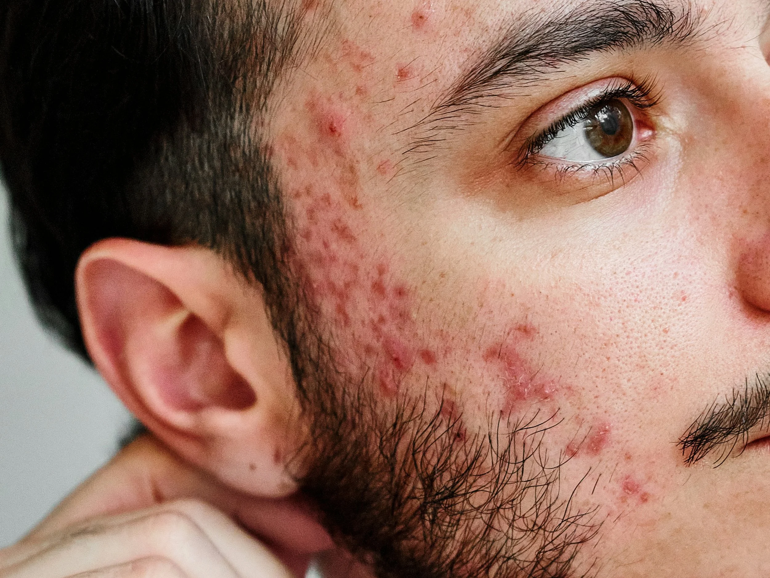 Close-up of a person's face showing redness and acne on the cheek and near the eye, with a focus on the eye and skin condition.