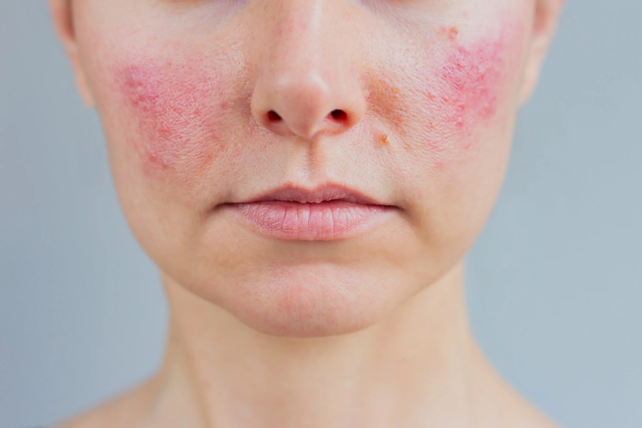 Close-up of a person's face showing skin redness and irritation on the cheeks and nose with visible pores and a small skin blemish.