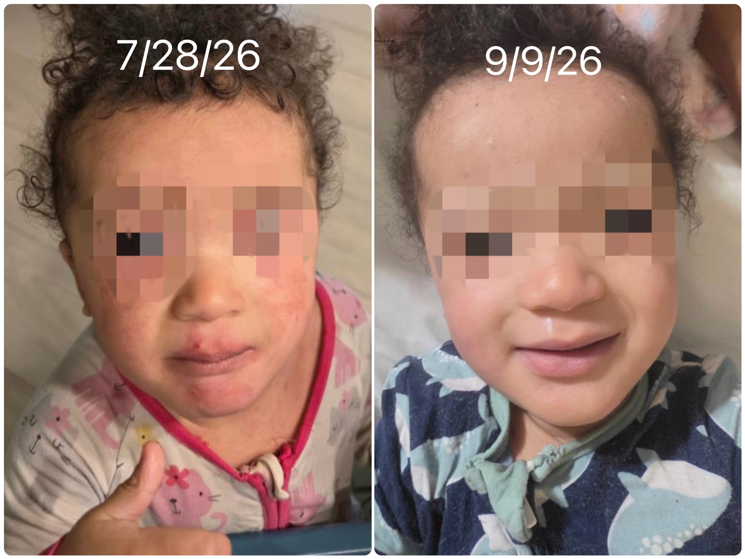 Eczema Progress with Chinese Herbs