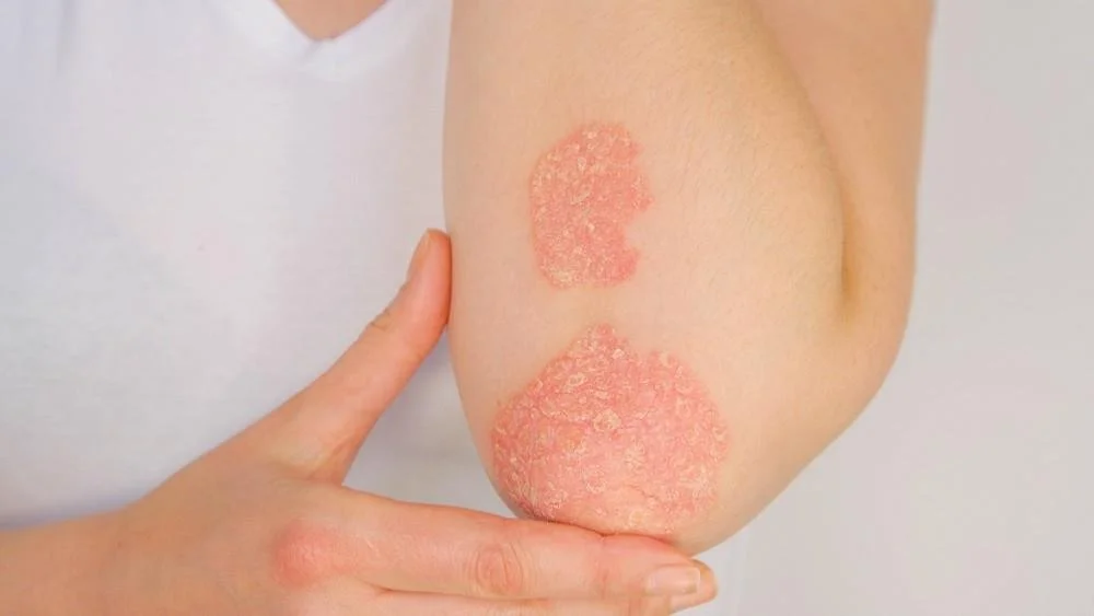 Close-up of a person's arm showing two patches of dry, red, and inflamed skin, possibly indicating rash or skin irritation.