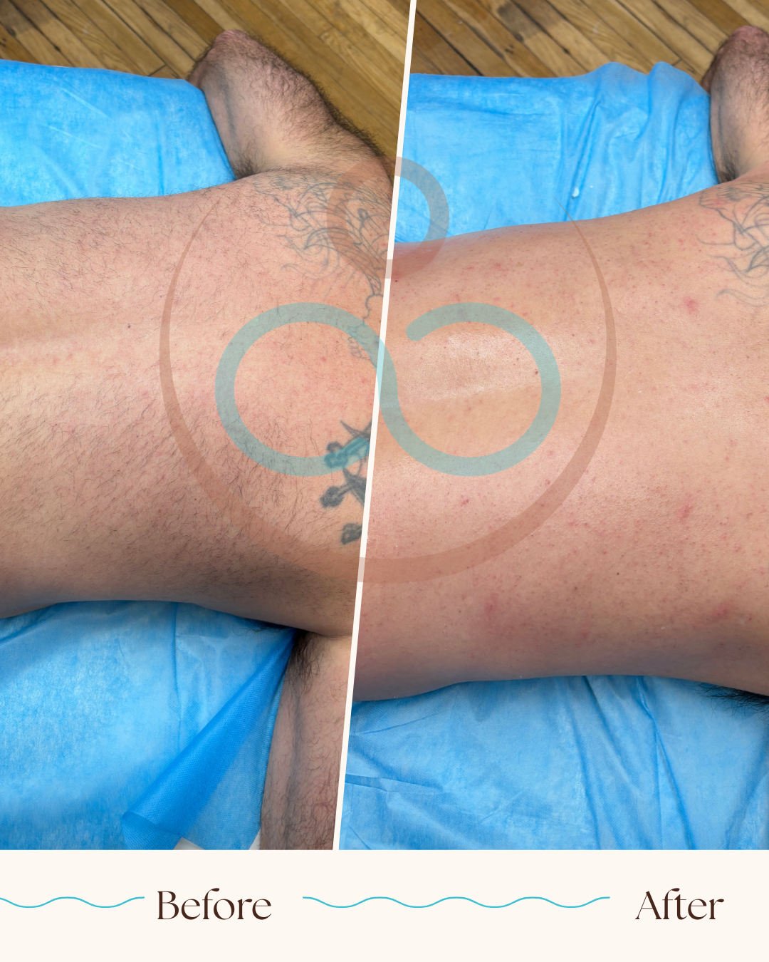 before and after photos of male back waxing session