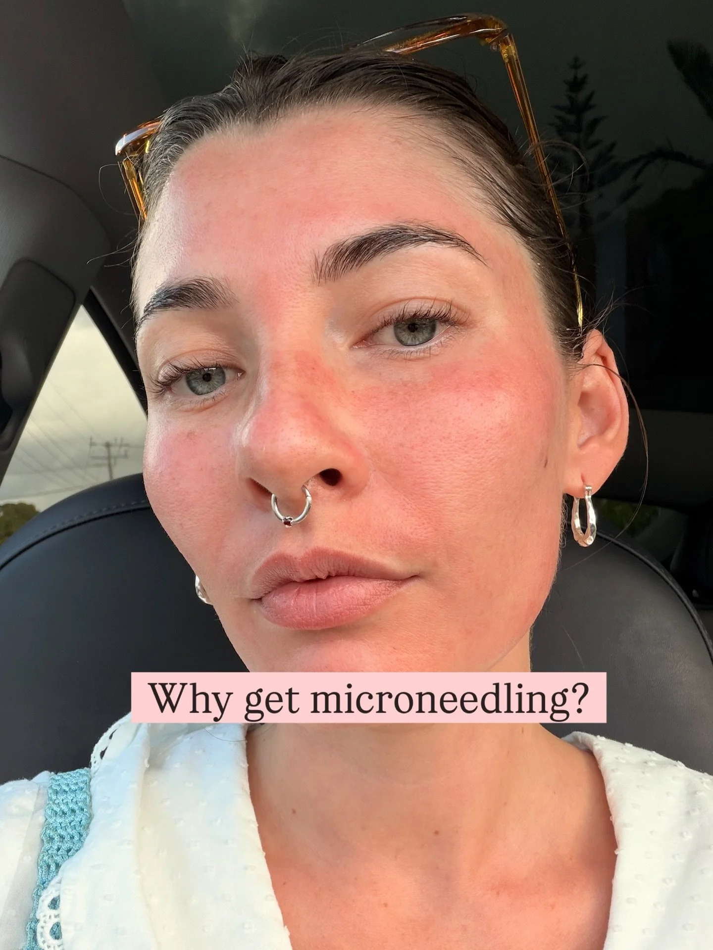 Temporary redness for long-term skin health &amp; glow
Trust the process ❤️

Micro-injuries, major results
Your future skin will thank you