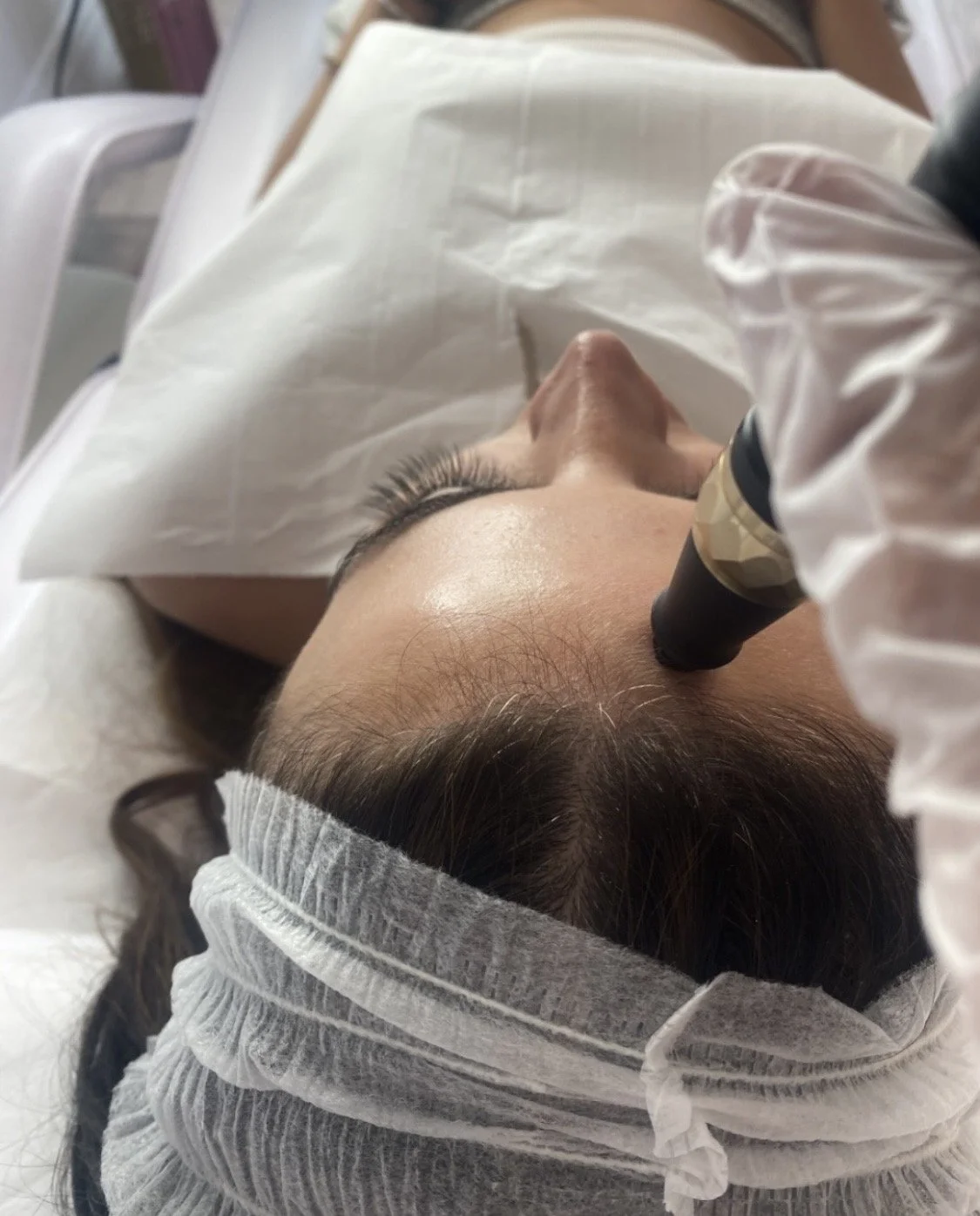 Microneedling device being used across the cheek to stimulate collagen production and refine skin texture