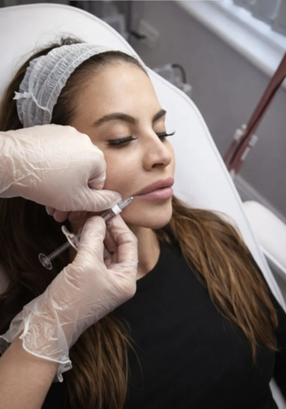 Subtle lip filler treatment adding soft volume and definition to the upper and lower lips at a medical aesthetics clinic