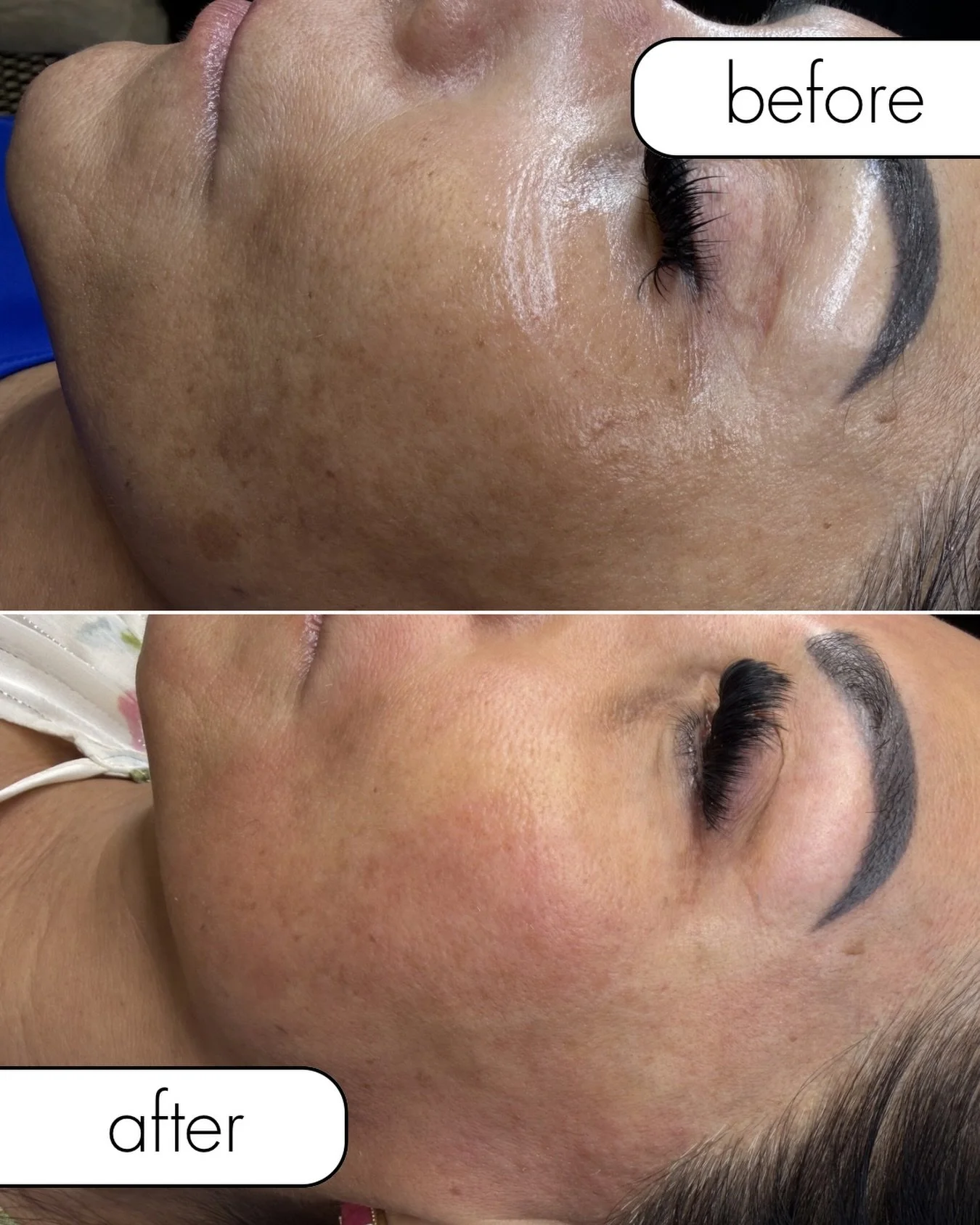 We focused on treating my clients hyperpigmentation + melasma.

We have achieved these results with SkinPen and Skinbetter home care. 

This is just one session imagine a full series 🤯😍

So proud of her consistency and trusting me to guide her skin