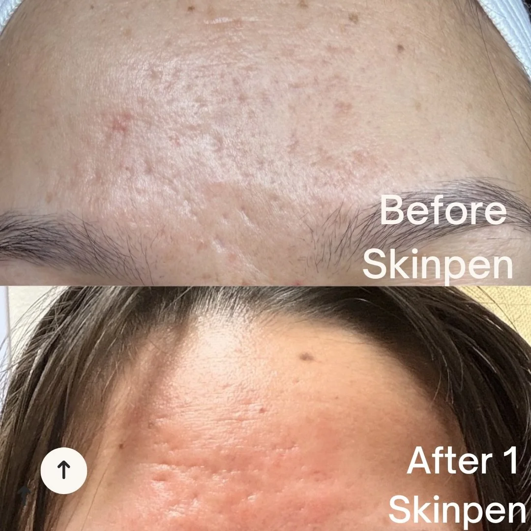 We are already seeing smoother texture, softer acne scarring and healthier skin

Microneedling with Skinpen creates micro-channels that stimulate collage repairing from within 
#skinpenprecision #microneedlingtreatment #albuquerque