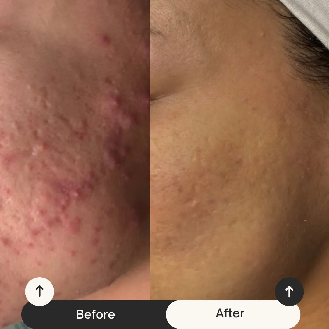 Struggling with inflamed  acne ? 

So was my client. I educated her on what would help her get the results she did and she understood the assignment! 

This is what coming in to her appointments and following her home care routine got her. 

If you&r