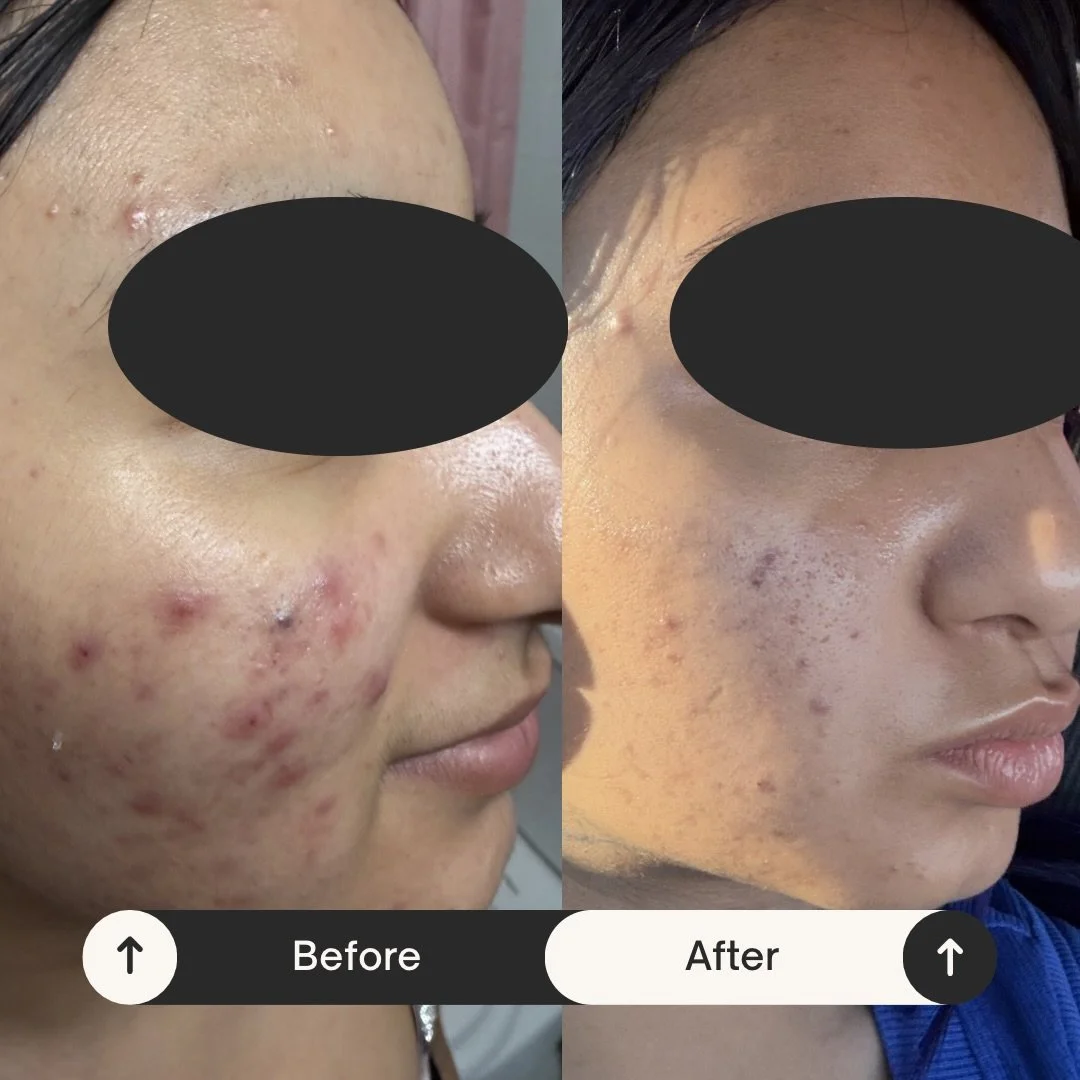 This is a perfect example of how the right  home skincare routine can definitely improve acne prone skin. 

Consistency pays off! This is a 3 week difference. And we are just getting started 🤍#acnetreatment #acnehomecare #estheticiannearme
