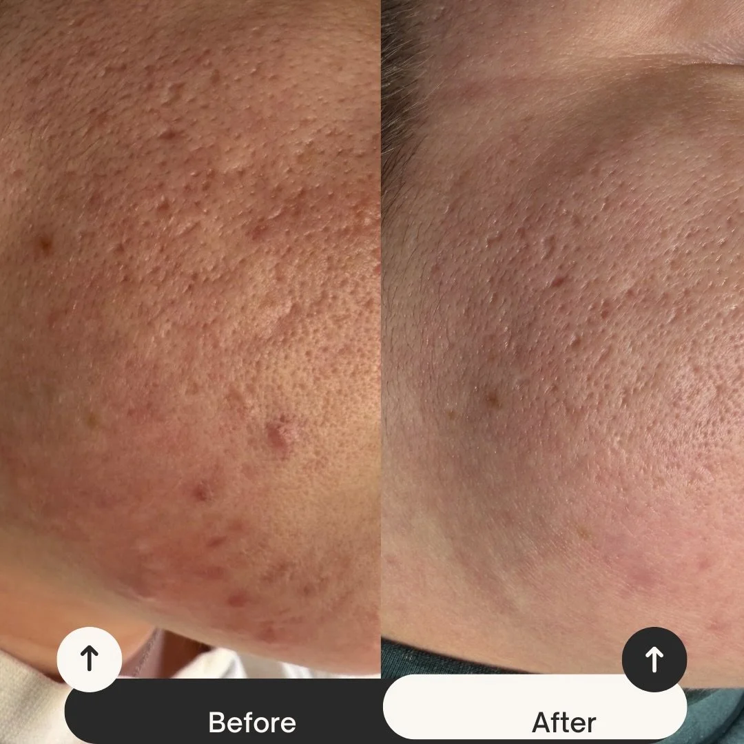 What does Skin Pen help with? 

This is my gorgeous client and this is after only one microneedling session with Skin Pen. 

I can&rsquo;t wait to continue to clear her acne and work on acne scarring. We just finished another session yesterday and wi