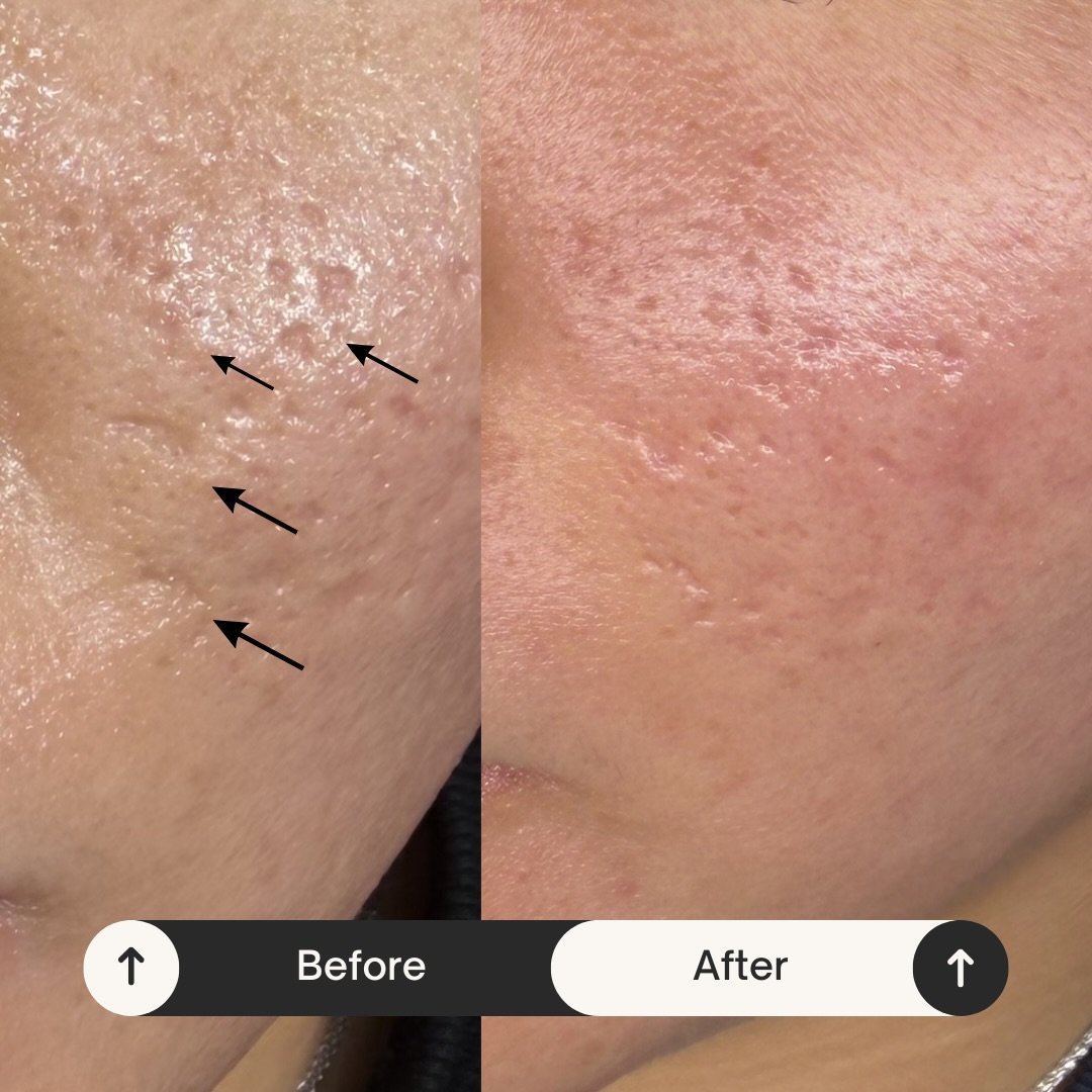 Acne scarring softened after micro-needling with Skinpen 

No guessing around here! Corrective treatment for this beauty 

She&rsquo;s on the right home care and coming in for her microneedling treatments 👏👏👏
#micronnedling #skinpenmicroneedling #