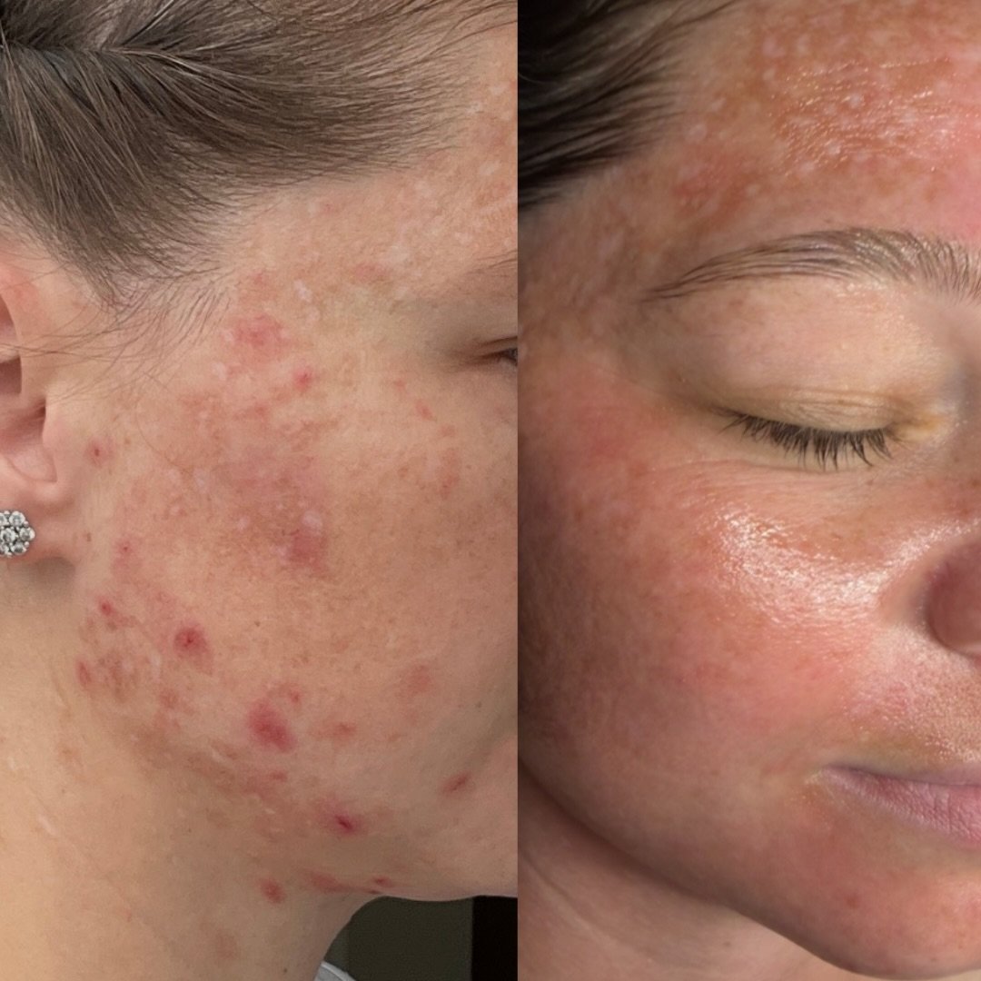 Another one of my beautiful clients that put in the work with her homecare,  eating habits and in room treatments! 

So proud of her 🥹👏👏
#facereality #clearacne #abqesthetician