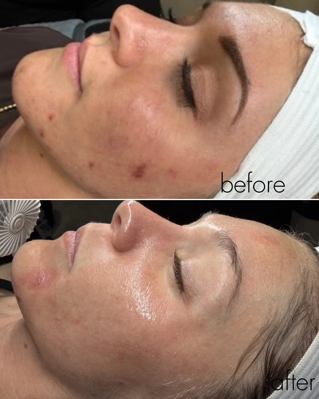 Acne correction isn&rsquo;t one service. It&rsquo;s a combination of corrective homecare, Advanced microneedling, and customized facials. 

I customize to each one of my clients skin needs. Not a one size fits all 🤍stop guessing start treating book 