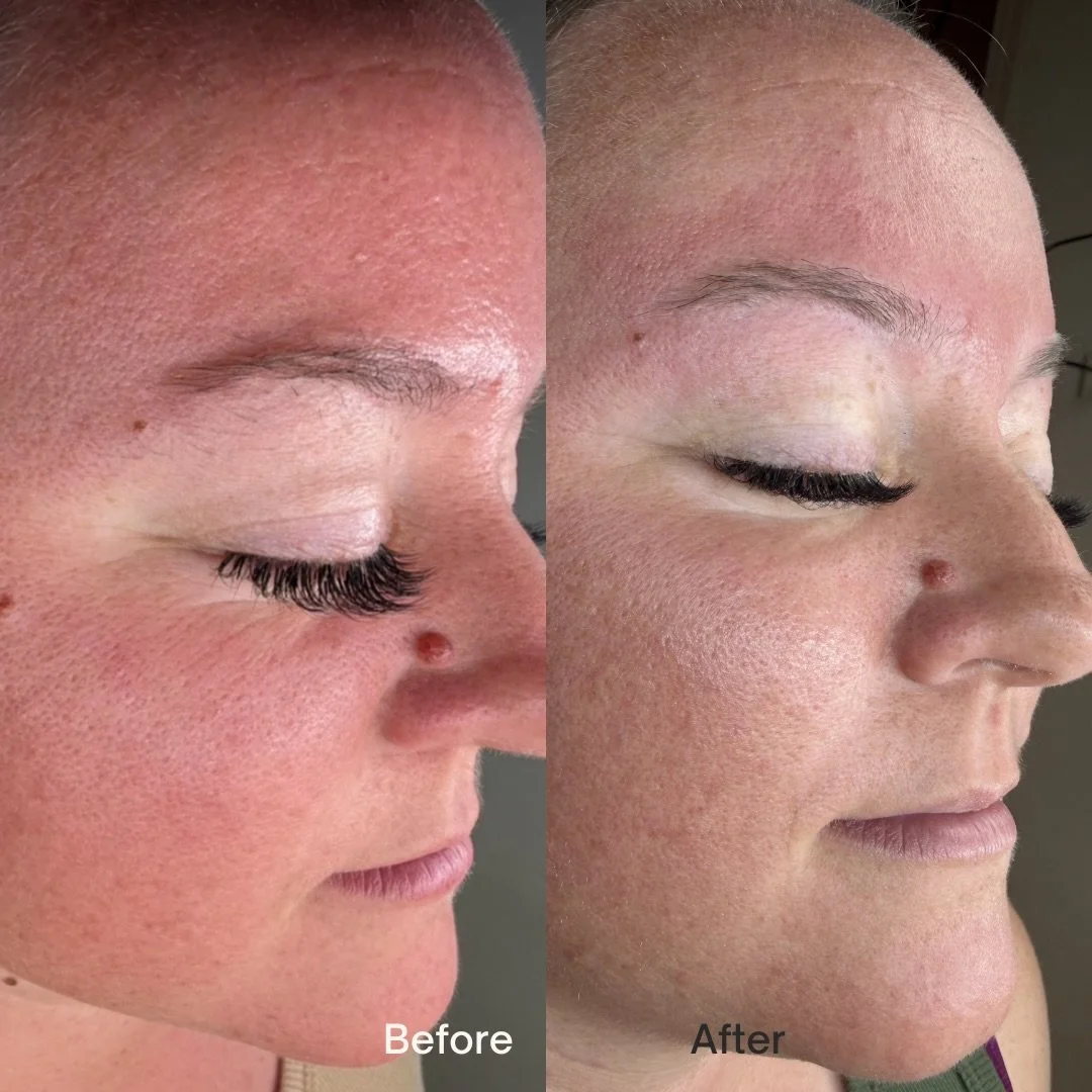 We&rsquo;re not just treating the surface
we&rsquo;re correcting the cause.

In just one treatment, you can already see:
&bull; Reduced overall redness + inflammation
&bull; Smoother texture across the forehead + cheeks
&bull; Less congestion and ref