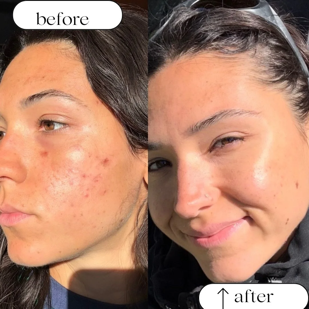 My client came in with some texture inflamed and non inflamed acne. We customized her treatment with a series of Skinpen +. 

As you can we results are in and her skin is glowing and looking amazing 😍 
If you struggle with acne/ acne scarring book y