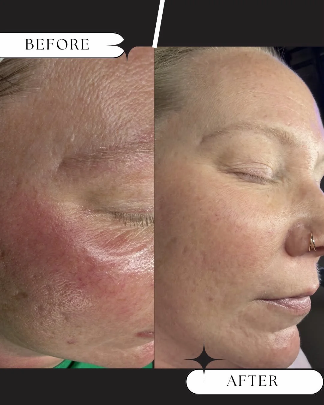Rosacea doesn&rsquo;t have to control your skin. ❤️
Results after just one microneedling session + customized home care.
Treatment included: 
SkinPen microneedling session

Customized home care recommendations

Consistency and patience

Struggling wi