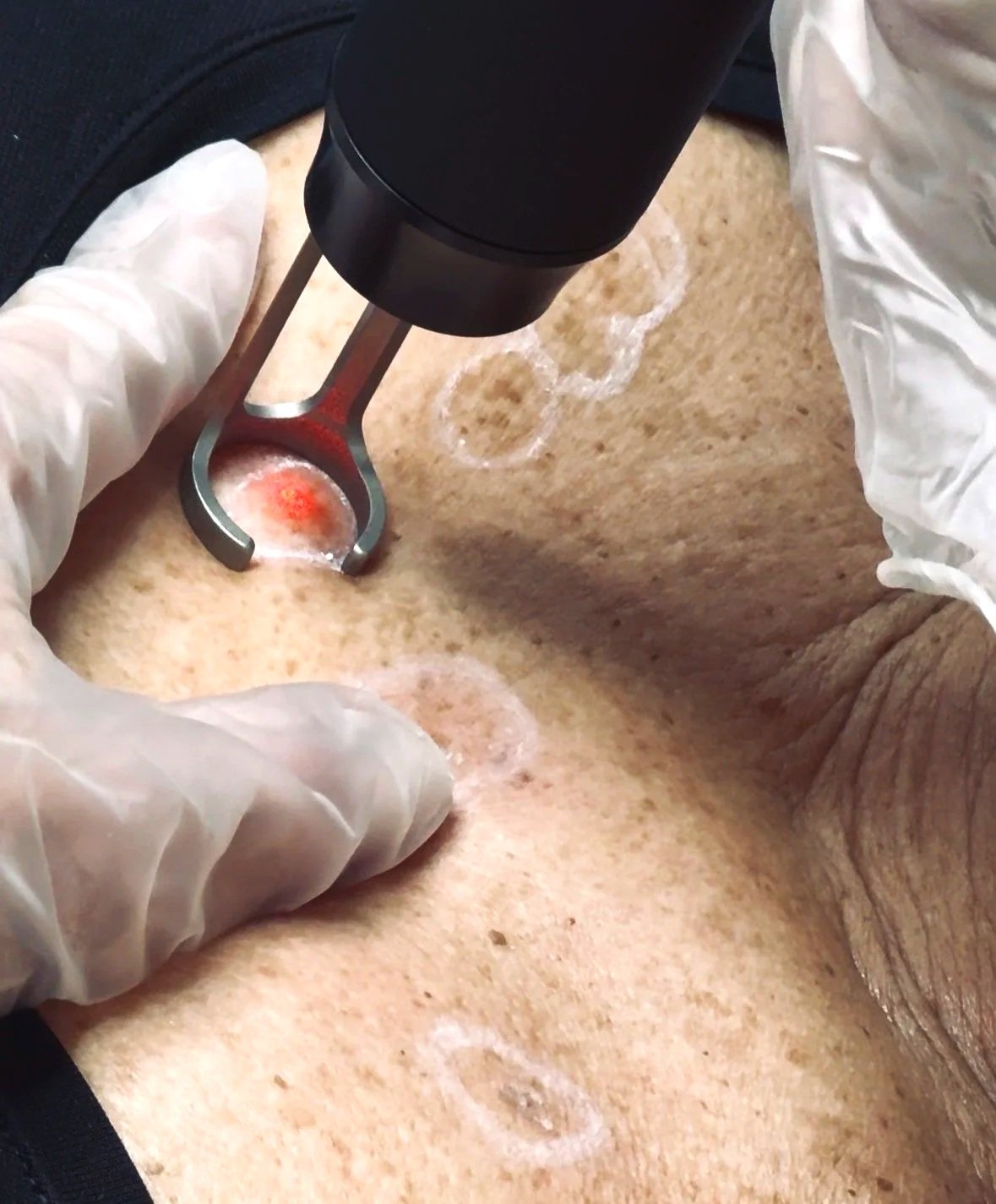 Procedura medica con strumenti che trattano la pelle di una persona. Processo di scarificazione o estrazione.