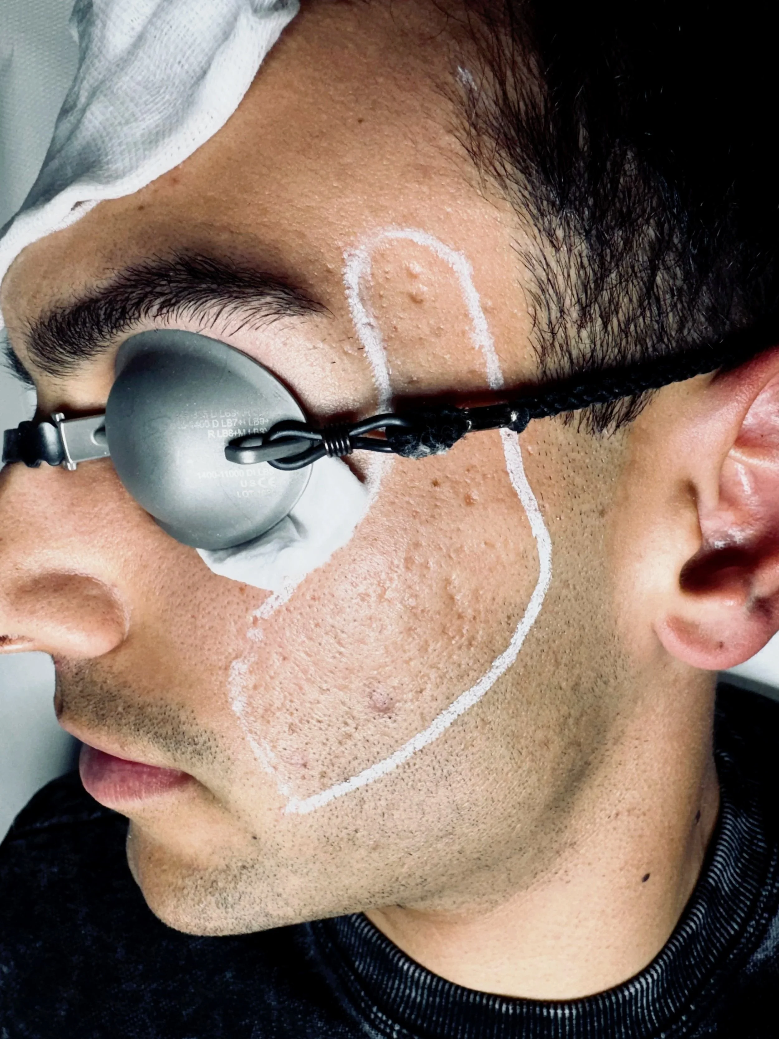 Primo piano di un uomo con marcature bianche sulla faccia, un dispositivo medico sugli occhi e una fascetta attorno alla testa, apparentemente durante un intervento o una procedura medica.