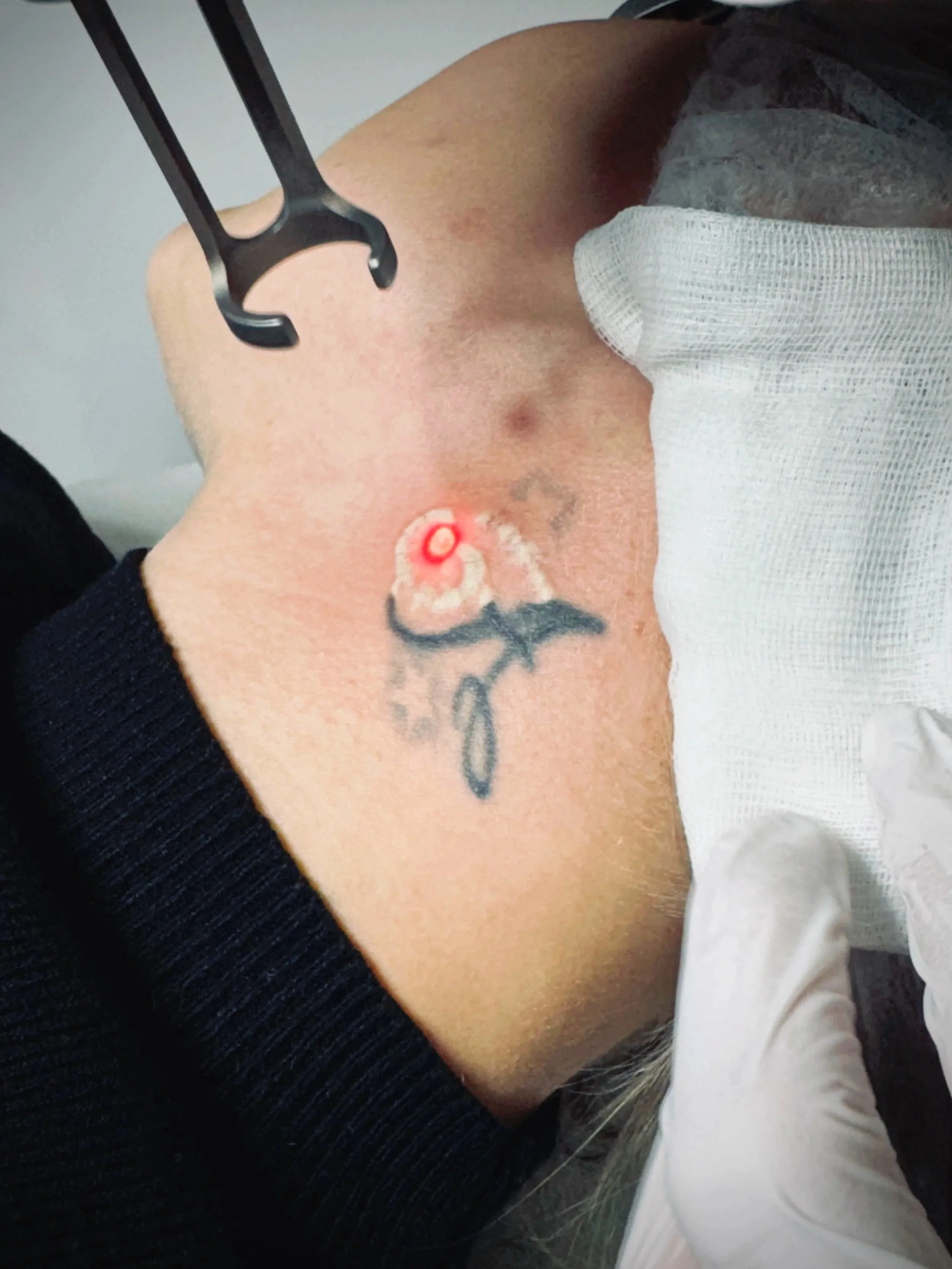 Una persona riceve un piercing sul collo, visibile un puntino rosso con un piccolo cerotto e un leggero gonfiore.